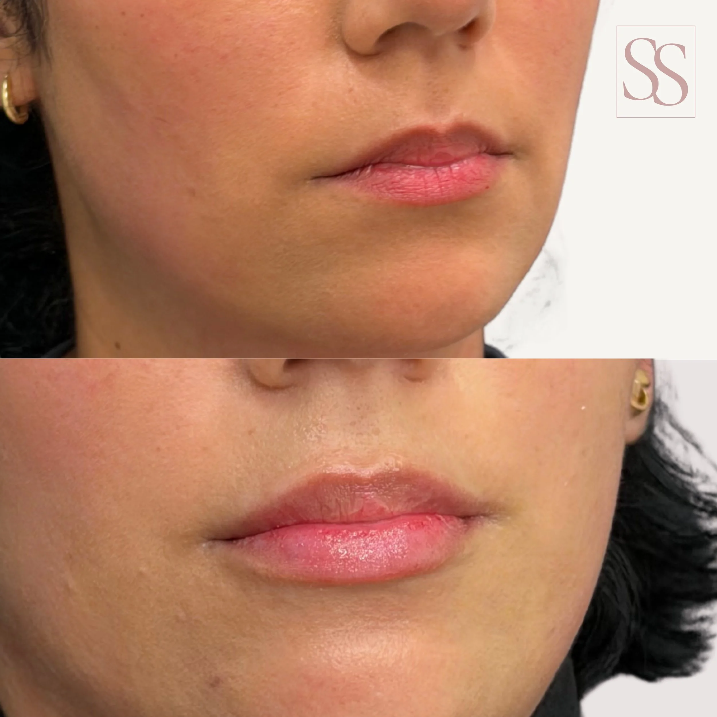 A little enhancement, a lot of impact. ✨

Softly restored volume and enhanced shape for a balanced, refreshed result that still feels completely like you.

Thoughtful placement. Subtle transformation. Beautiful results. 🤍

Ready for your refresh? Bo
