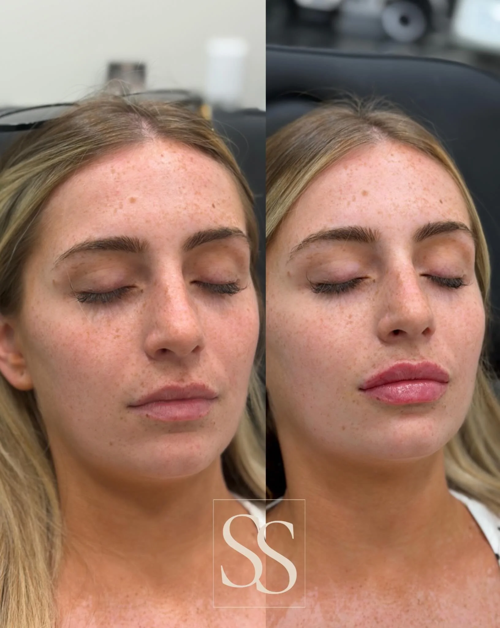 A little volume, a lot of balance 💋
Subtle lip enhancement with dermal filler for the prettiest, natural-looking pout💉

Book your appointment through the link in my bio🔗