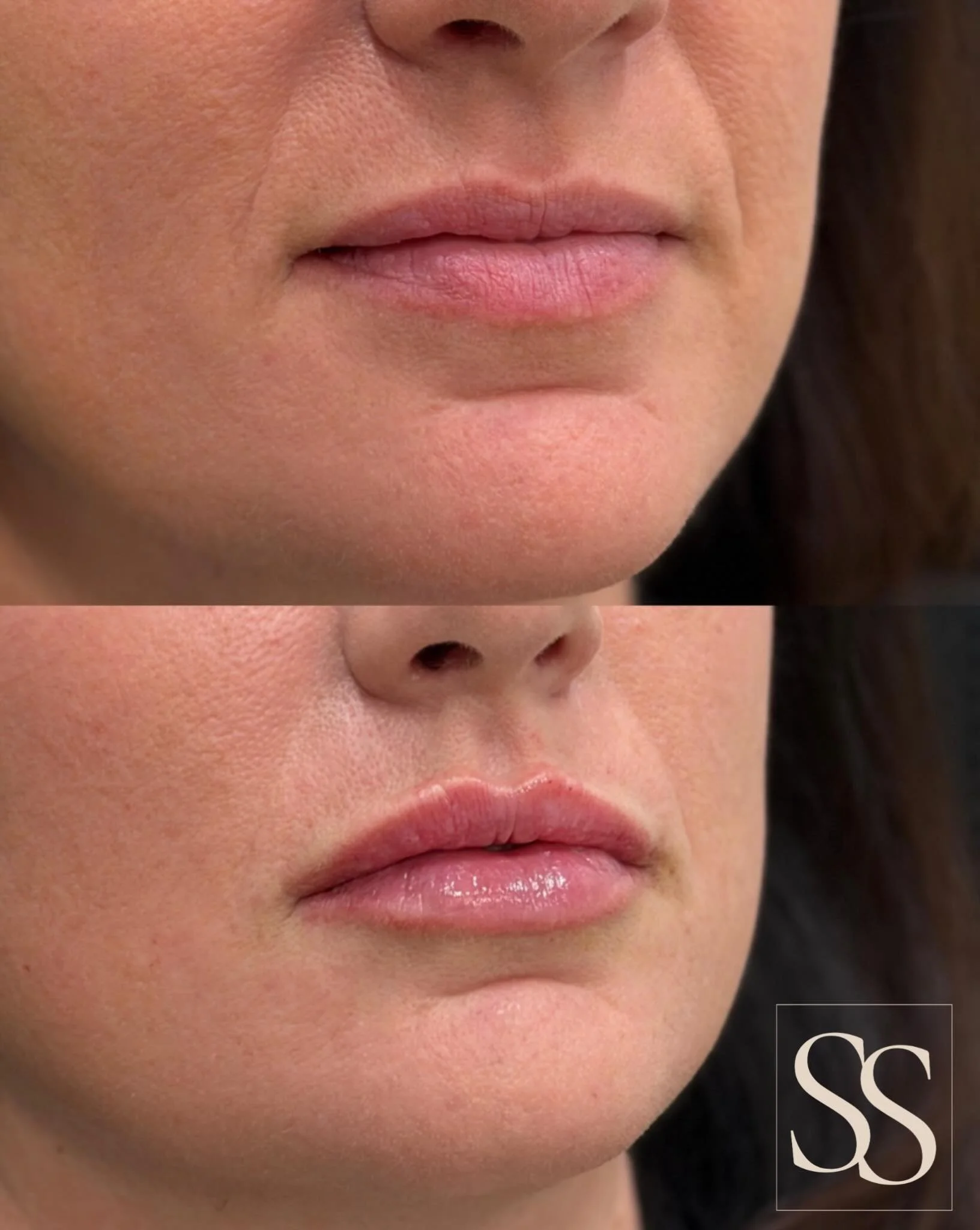 Soft volume, beautiful definition 📐The perfect little refresh with dermal filler while keeping things natural.

Click the link in my bio to book🤩