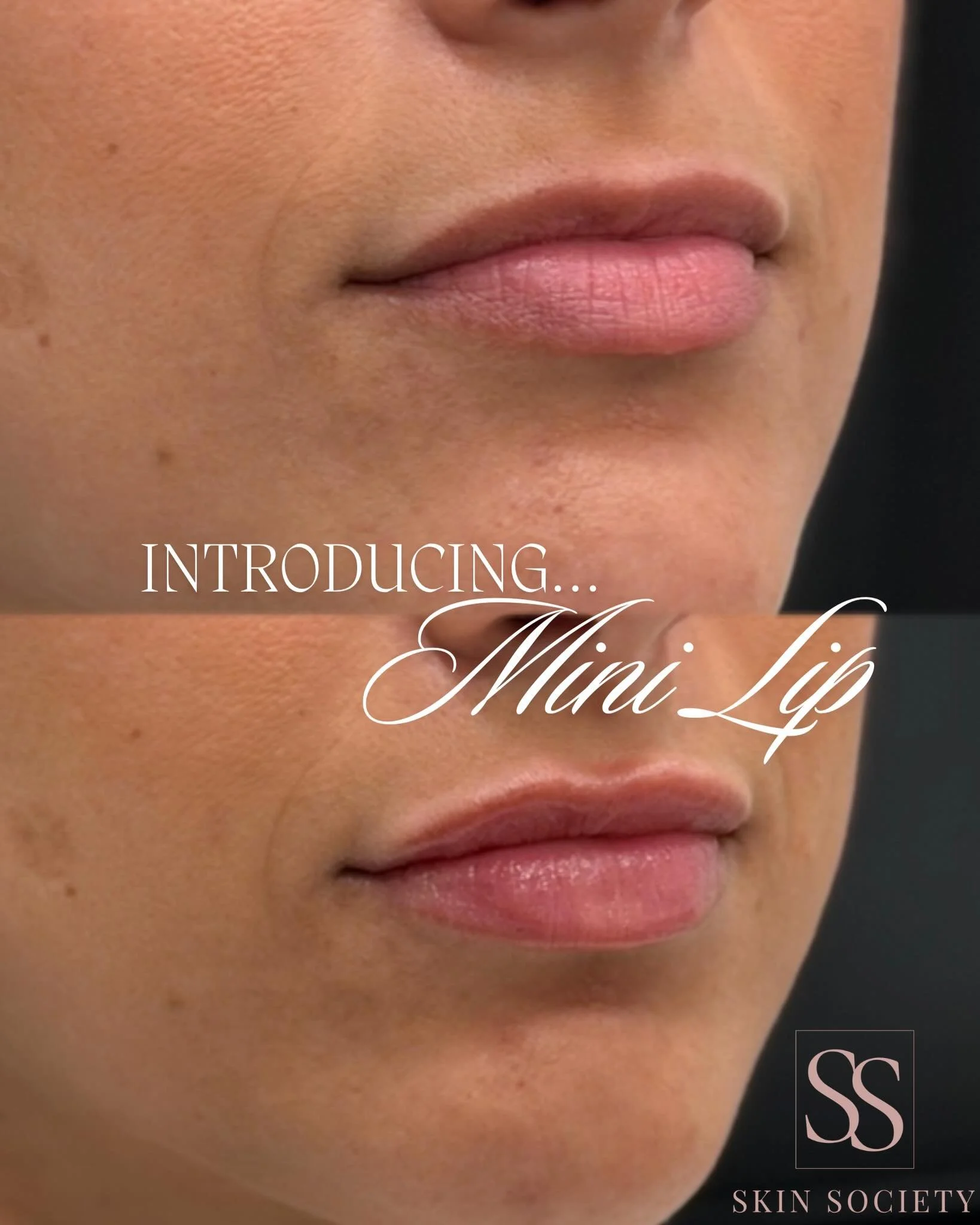 Introducing the Mini Lip 💋
Think natural hydration + the perfect plumping lip gloss effect &mdash; with just &frac12; a syringe. 
With little to no downtime, this is the undetectable filler you didn&rsquo;t know you needed. 

Book through the link o