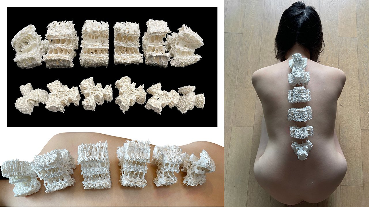 Multiple pieces of white porous material resembling sponges or coral, arranged on a black background and on a person's back for anatomical comparison.