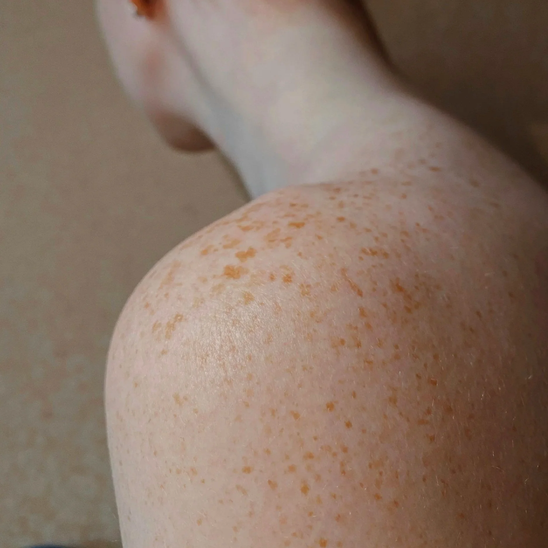 Close-up of a person's leg with light skin and orange freckles, showing part of the thigh and knee, with a neutral background.