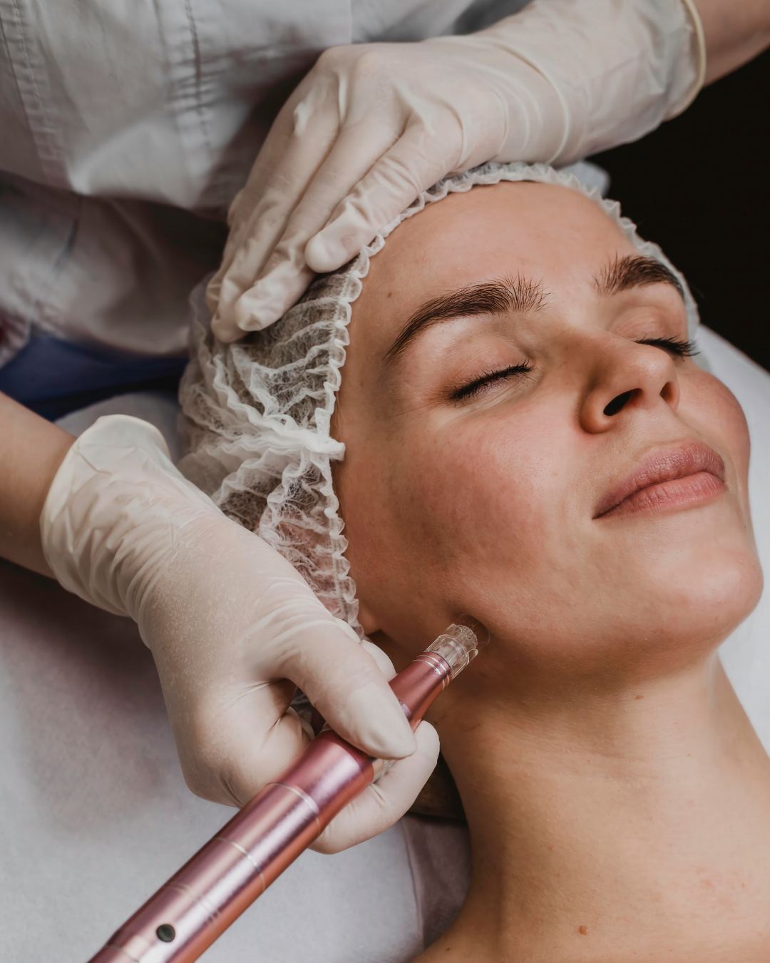 Medspa in Sonoma, CA, 95476 Microneedling Near Me.png