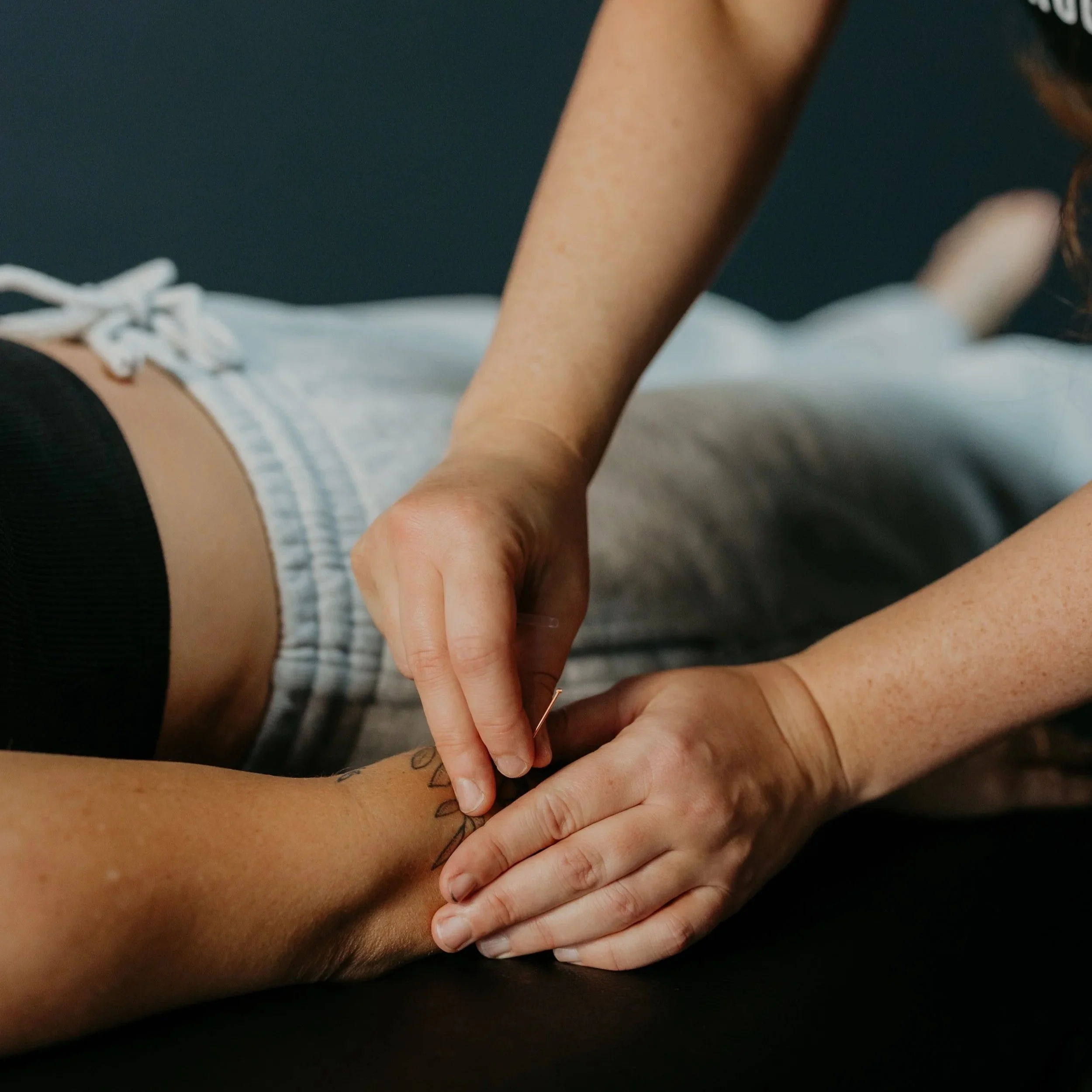 A person receiving acupuncture treatment, with needles inserted into their arm.