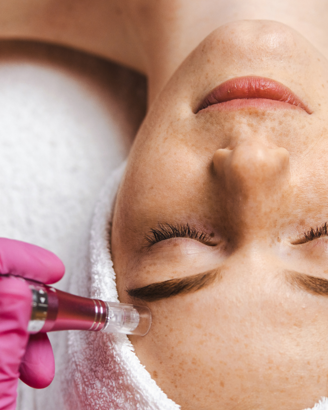 Medspa in Holmdel, NJ, 7733 Microneedling Near Me.png