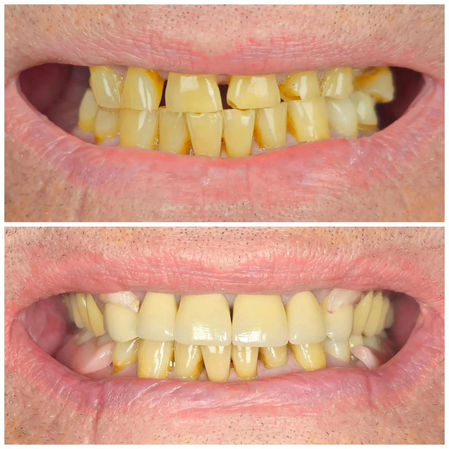 Comparación de dientes con mal aliento y caries en la parte superior y dientes limpios y saludables en la parte inferior.