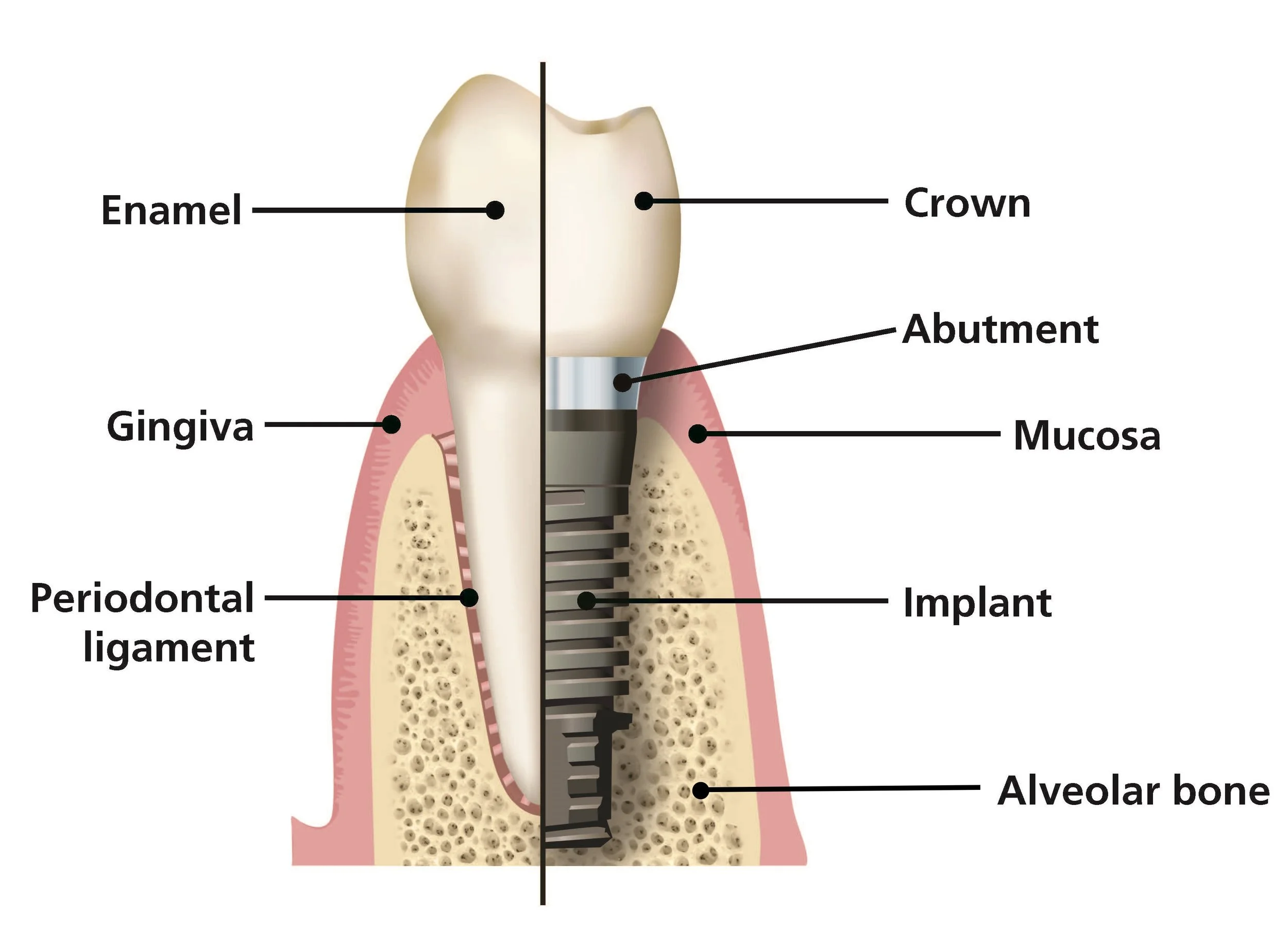 toothvimplant_labels-small.jpg