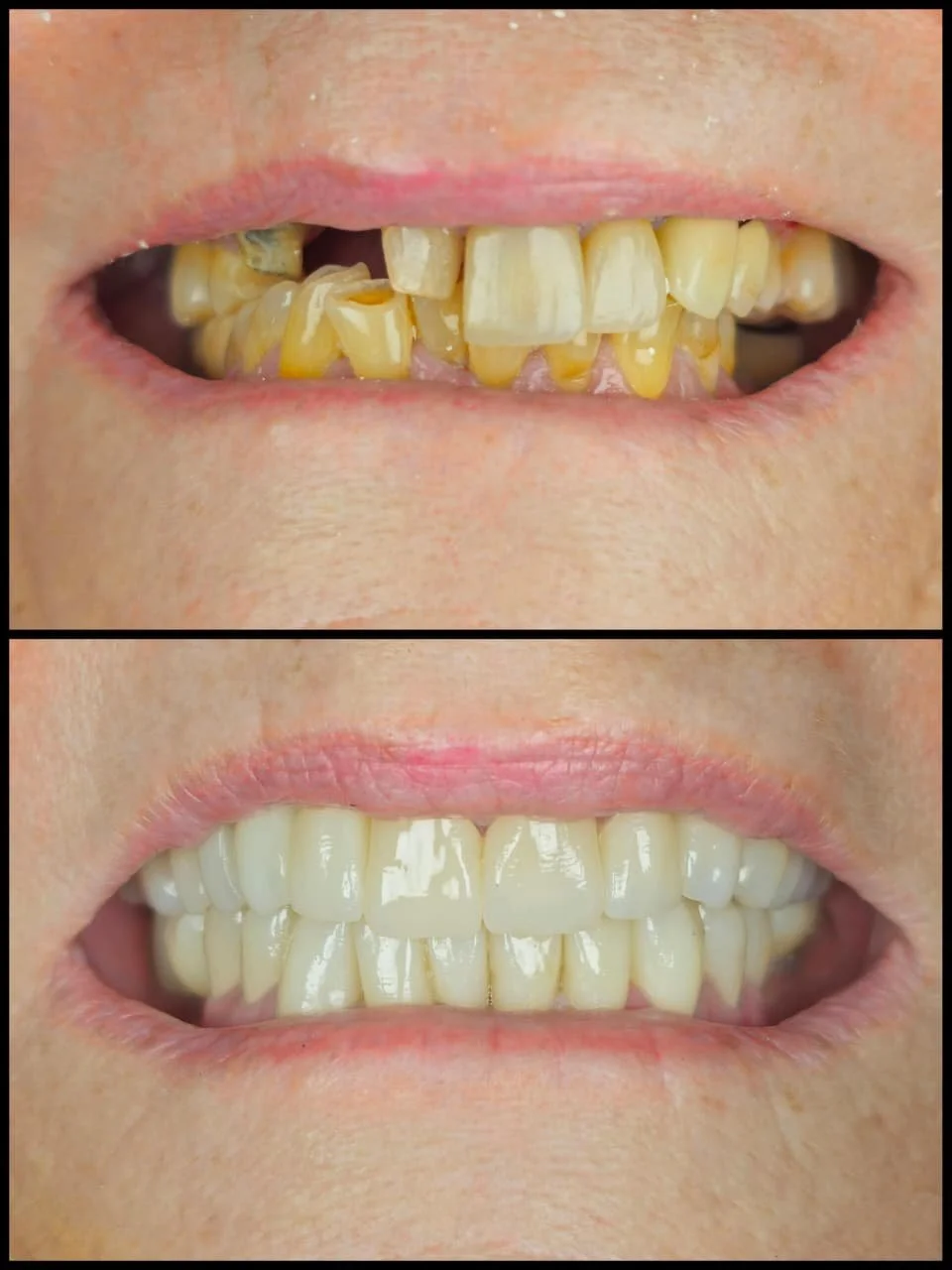Antes y después de un blanqueamiento dental. La parte superior muestra dientes amarillentos y dañados, la parte inferior muestra dientes blancos y saludables.