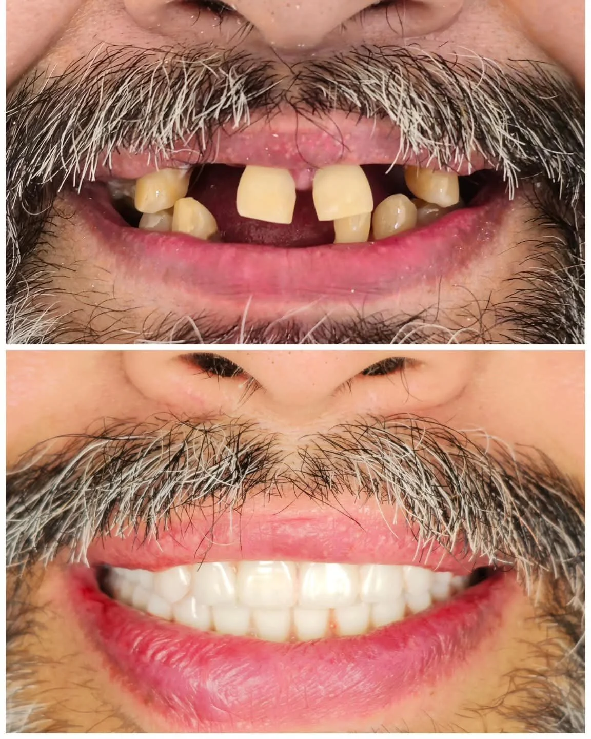 Antes y después del tratamiento dental, mostrando mejora en la alineación y apariencia de los dientes.