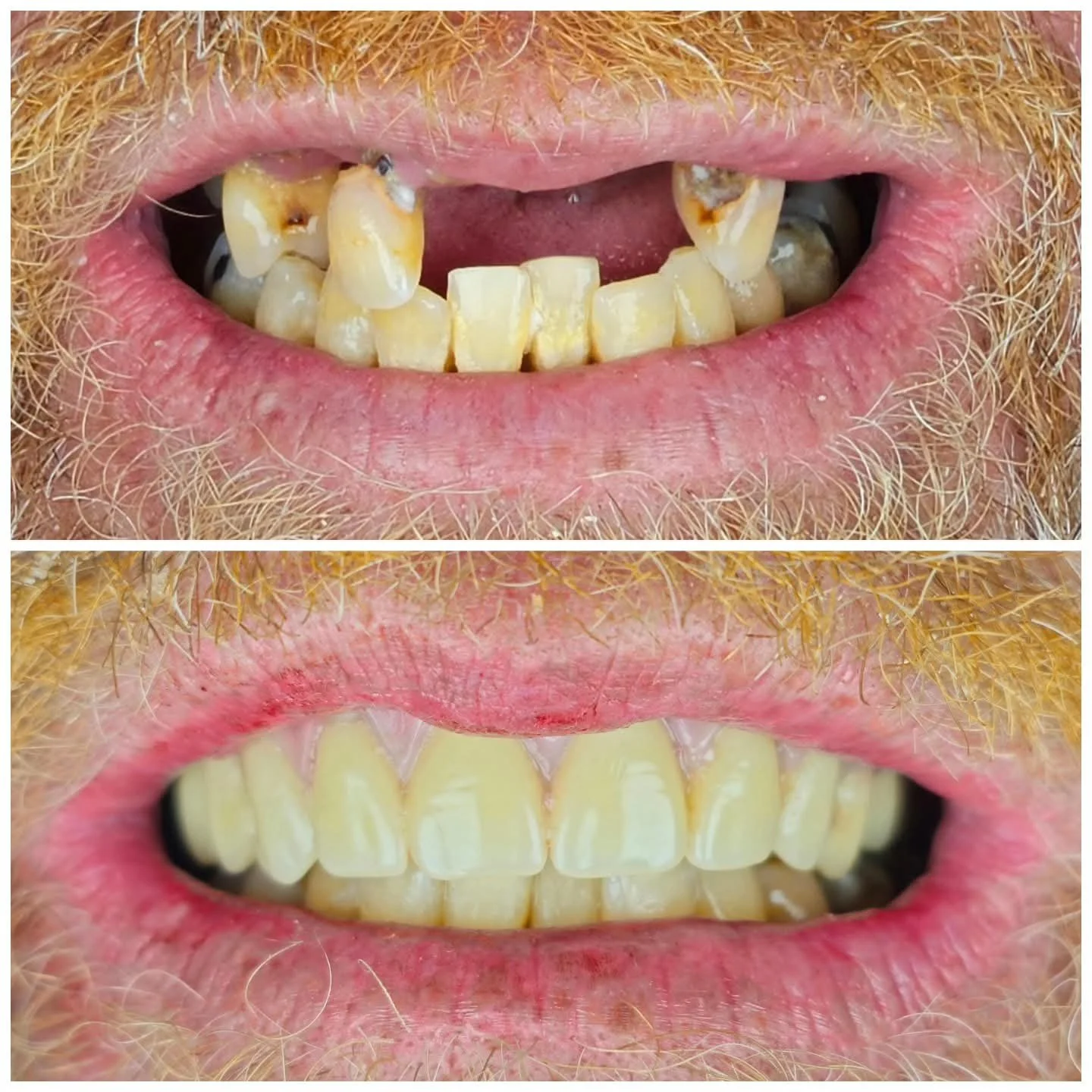 Comparación de dientes con problemas de higiene bucal y dientes sanos, mostrando en la parte superior dientes con caries, acumulación de placa y mal estado, y en la parte inferior dientes limpios y sanos.