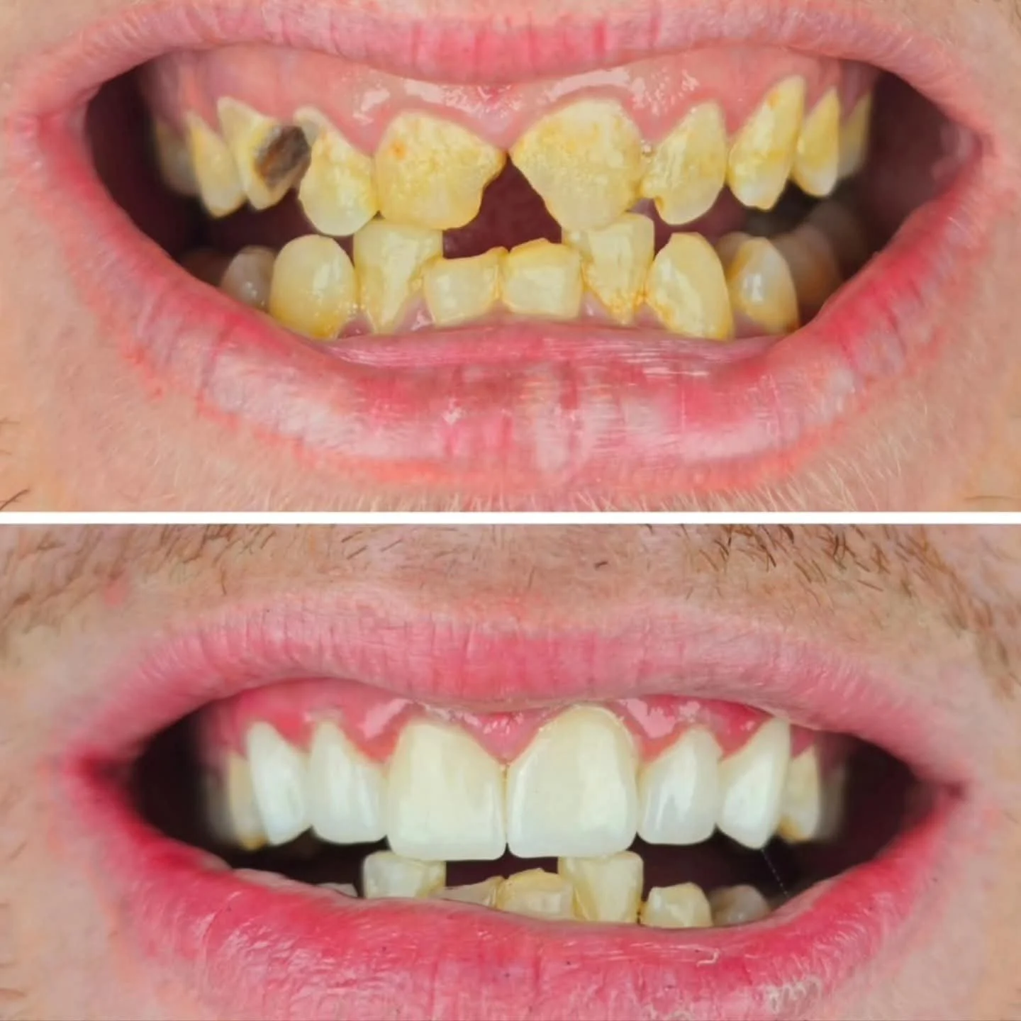 Antes y después de un tratamiento dental que muestra la mejora en la apariencia de los dientes, de dientes con caries y amarillentos a dientes blancos y sanos.