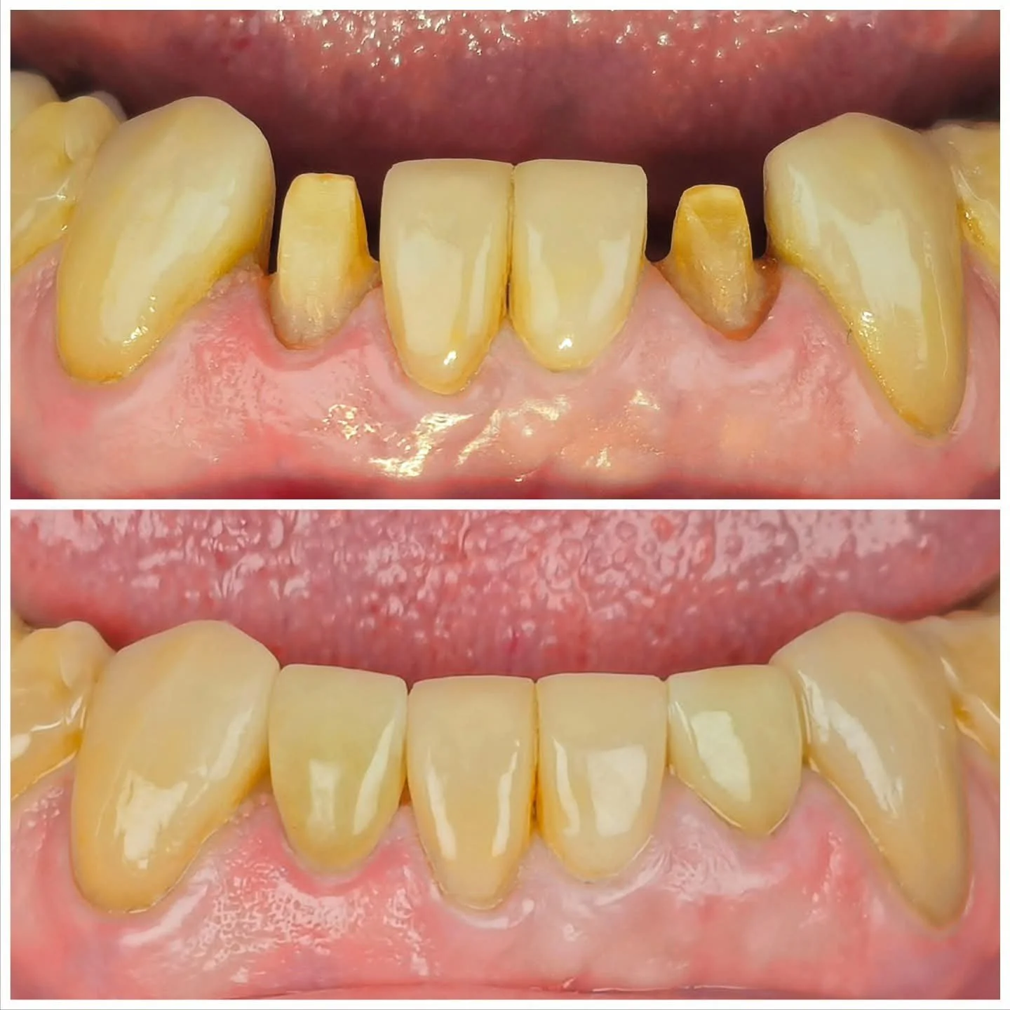 Fotografía de una boca con dientes amarillentos, con algunos dientes en mal estado y encías inflamadas en la parte superior, la segunda imagen muestra una sonrisa con dientes limpios y saludables.