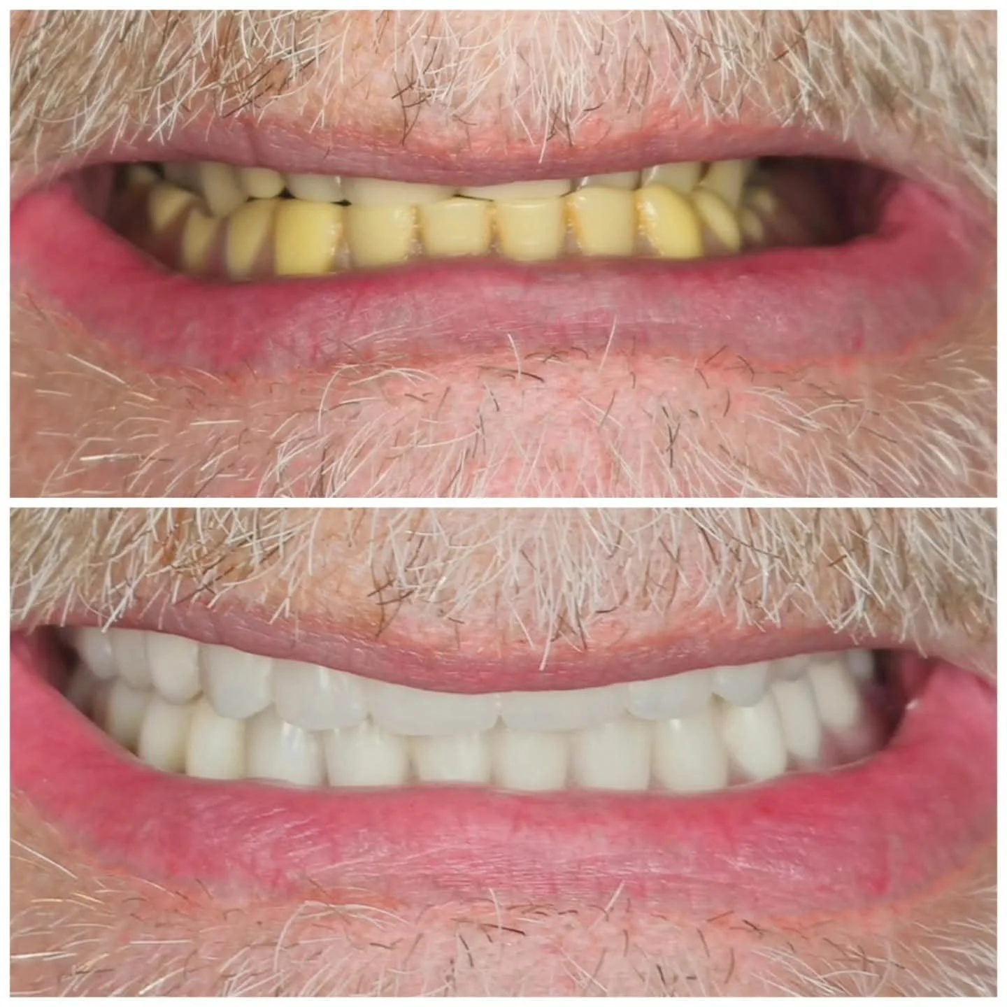 Primer plano de la boca de una persona mayor, mostrando dientes amarillentos y sufriendo desgaste dental. La segunda imagen muestra la misma boca después de un tratamiento dental, con dientes blancos y saludables.
