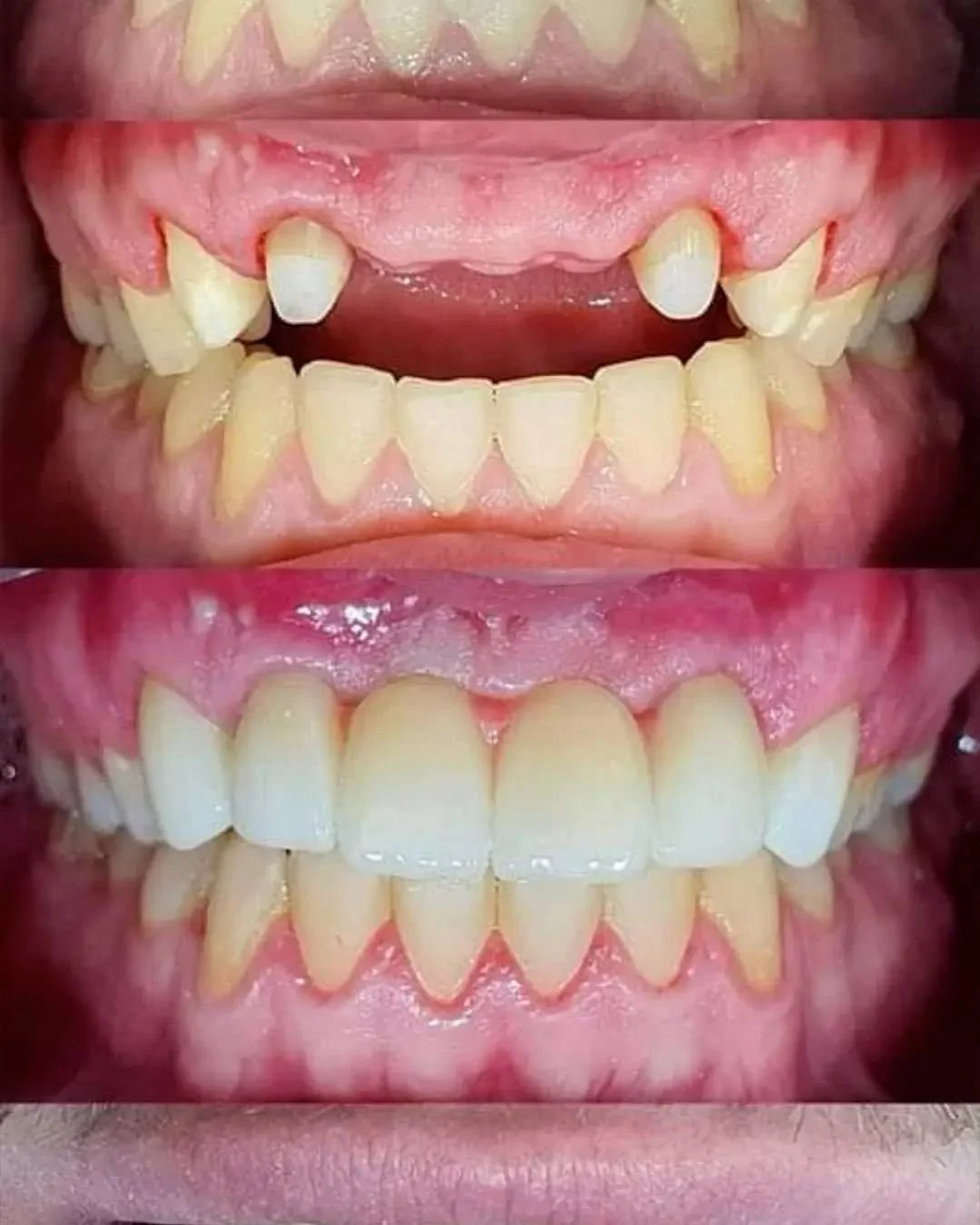 Tres imágenes de dientes y encías en diferentes condiciones, mostrando dientes con problemas, mejorados en la última imagen.