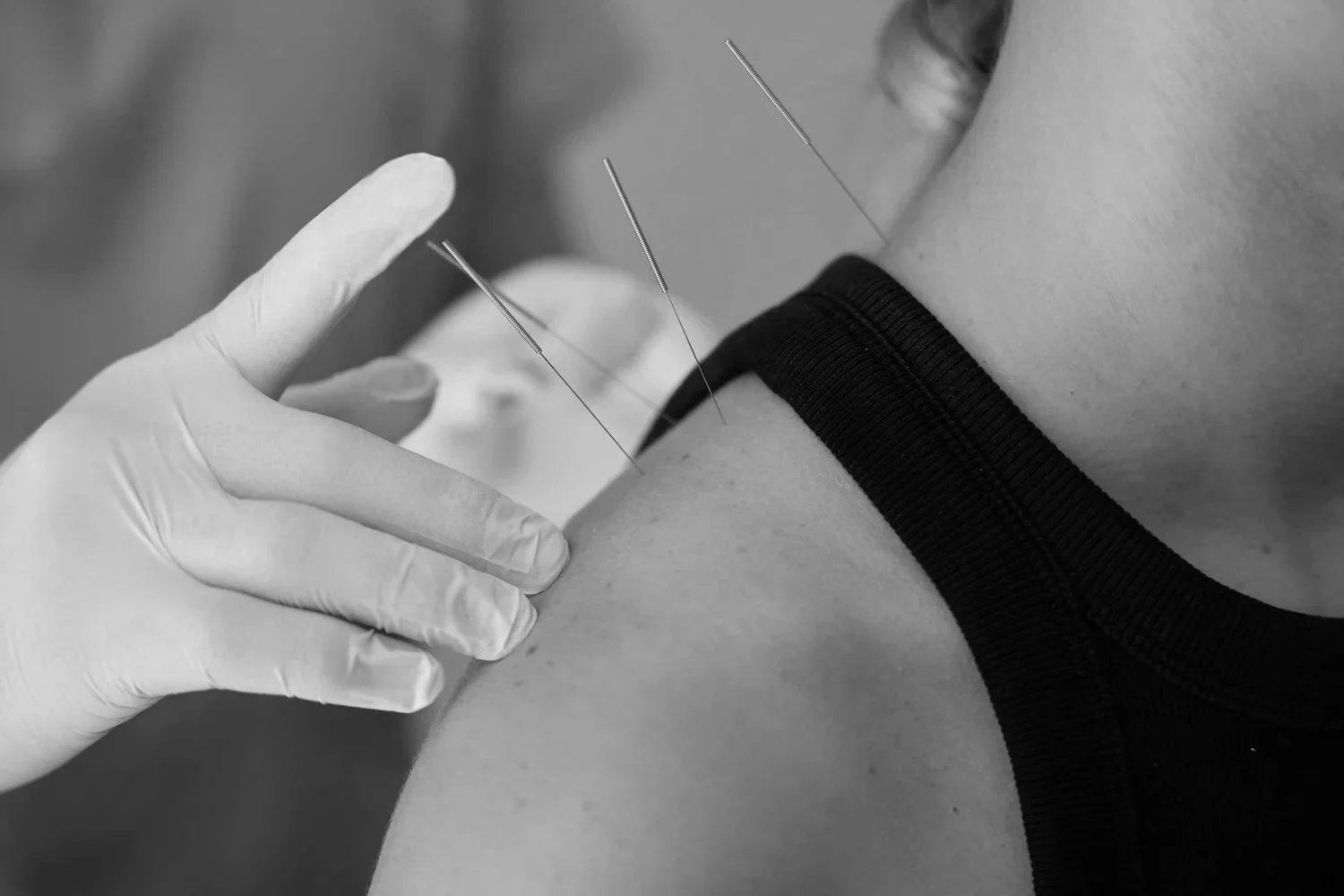 A person receiving an acupuncture treatment on their upper arm, with a healthcare provider wearing gloves inserting thin needles.