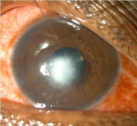 Close-up of an eye with cloudy or opaque cornea, possibly indicating a medical condition.