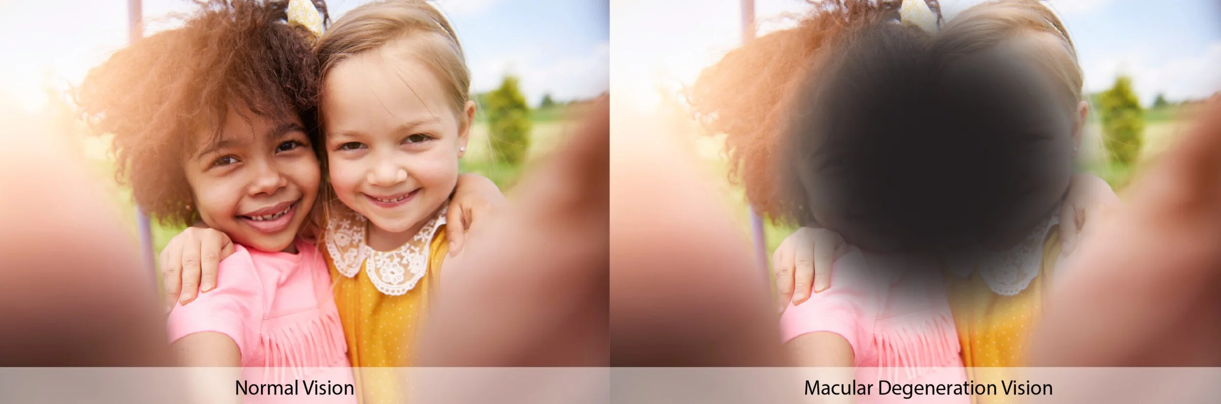 Two young girls smiling and hugging outdoors, with a blurred background of trees and sky, comparing normal vision and macular degeneration vision.