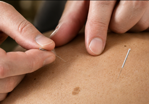 Acupuncture treatment at Purple Clover Acupuncture