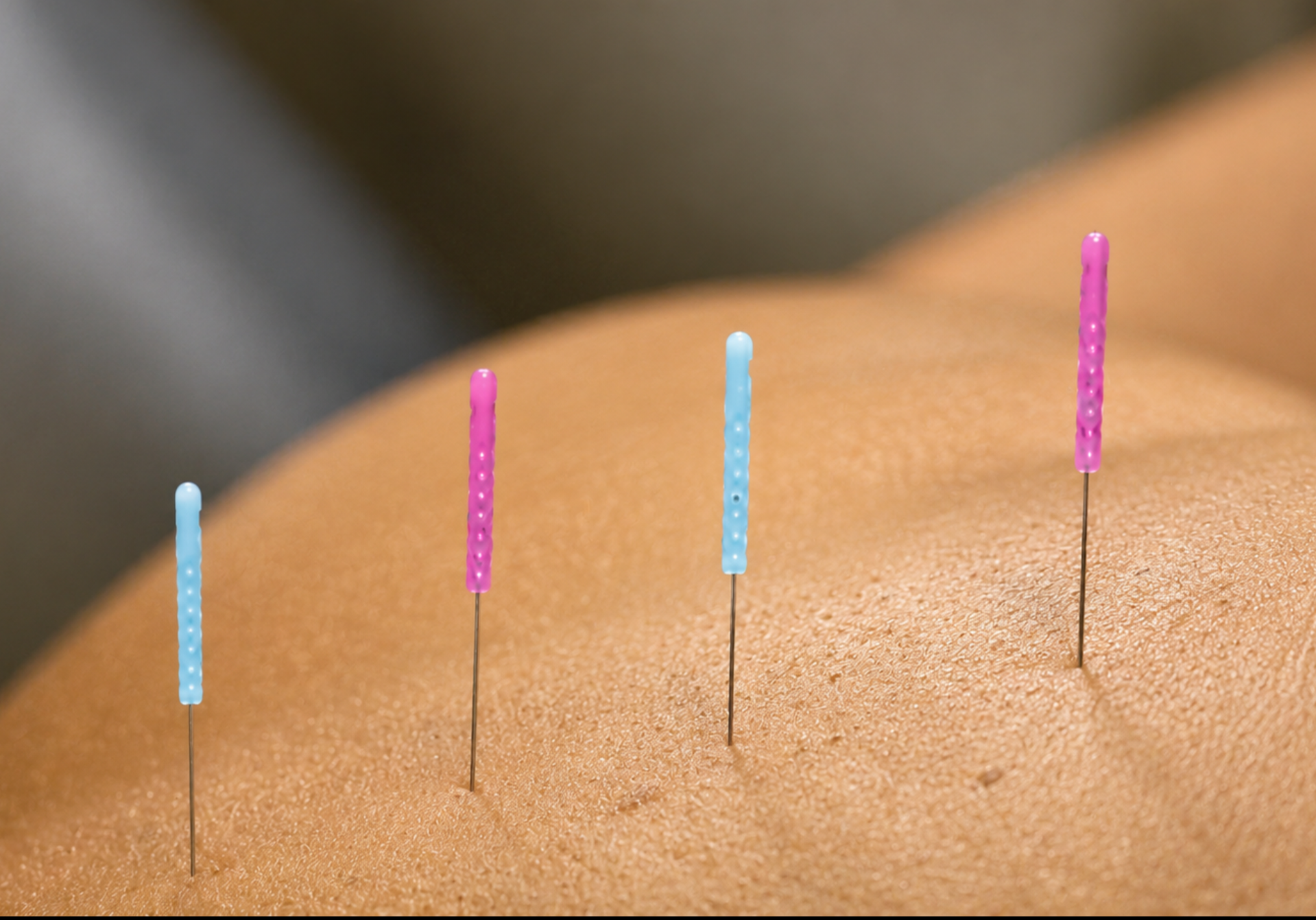 Acupuncture treatment at Purple Clover Acupuncture in Malden MA