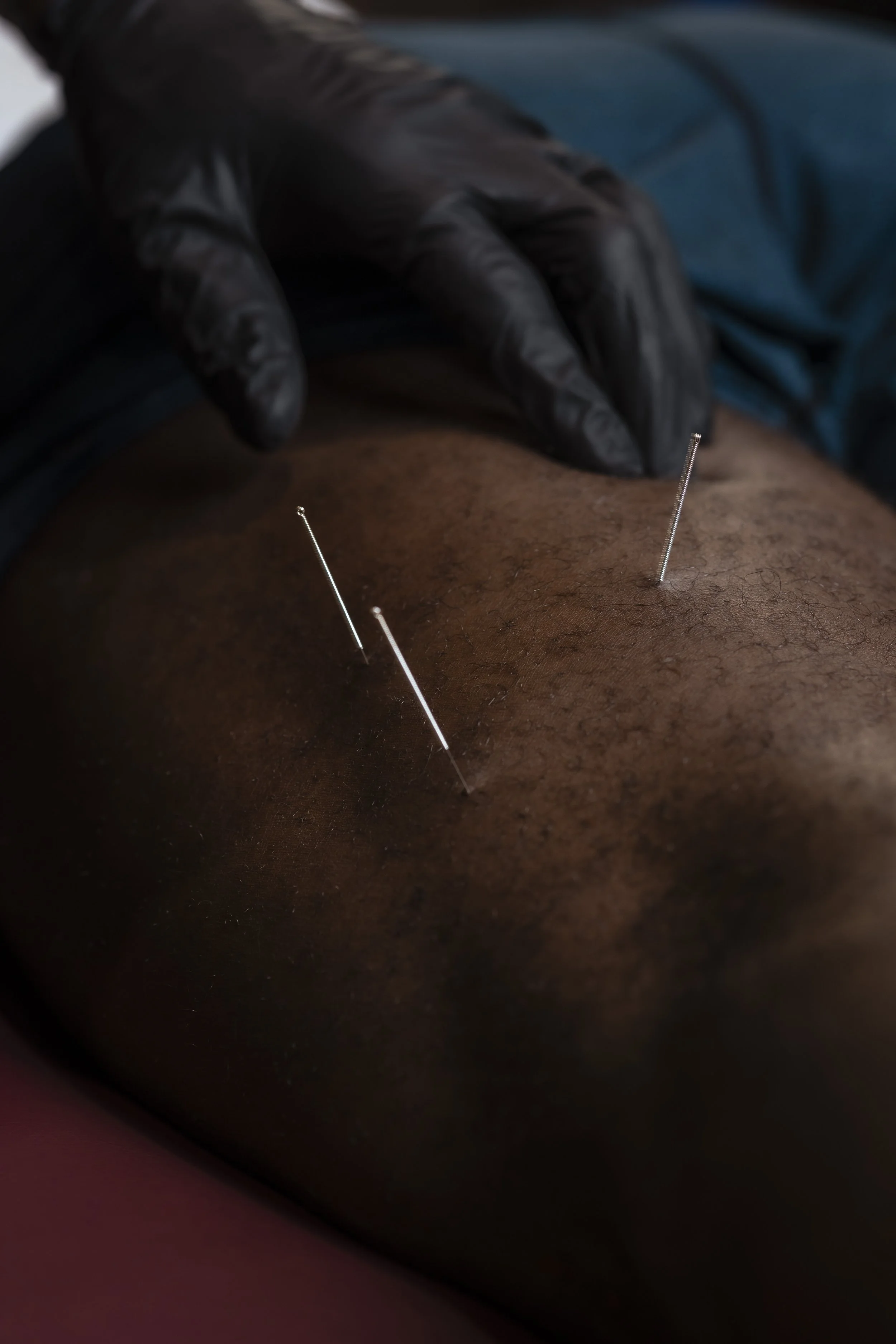 Close-up of a person's skin receiving dry needling with several thin needles inserted and a gloved hand applying pressure.