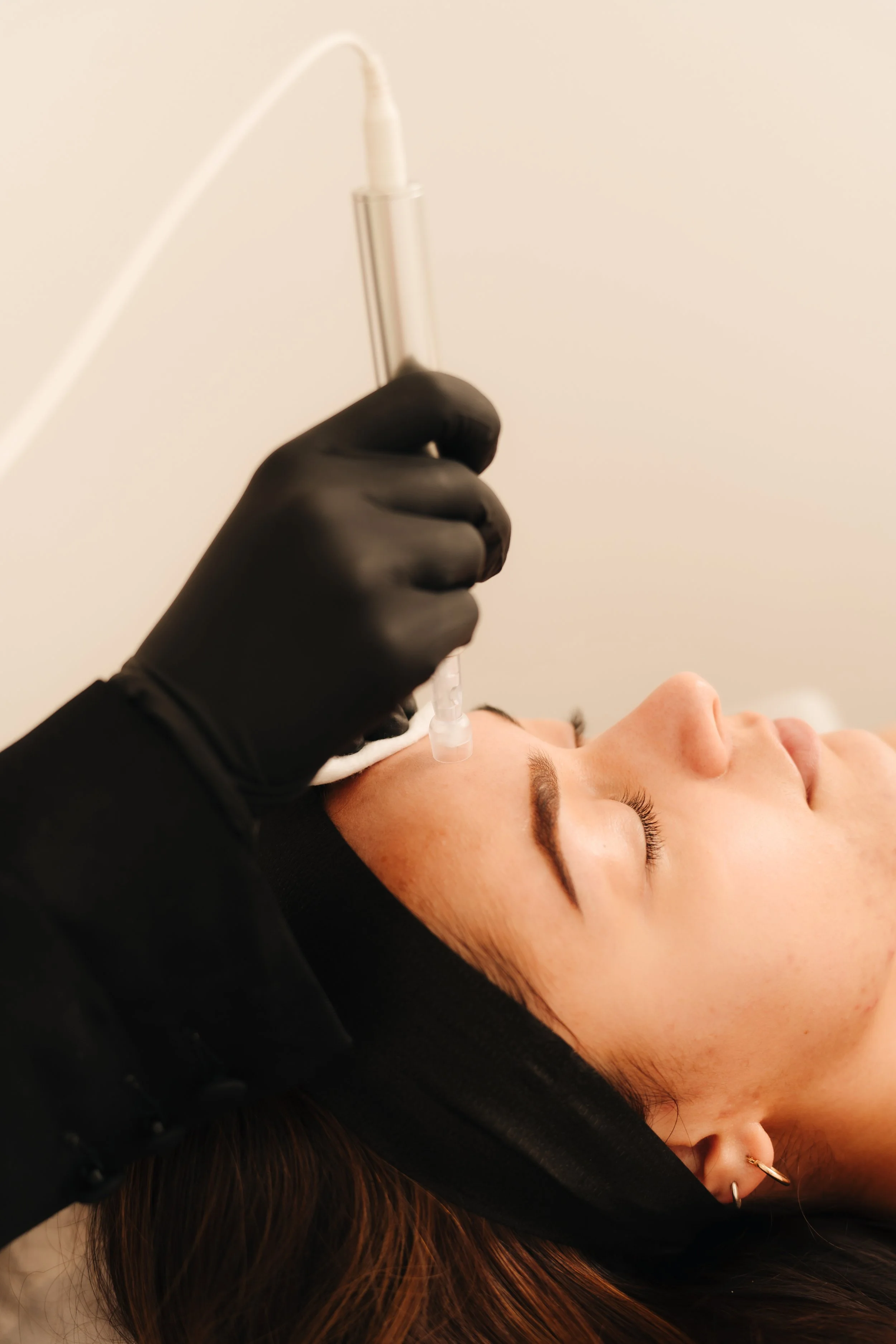 Why Skin Needling Remains the Gold Standard for Skin Health