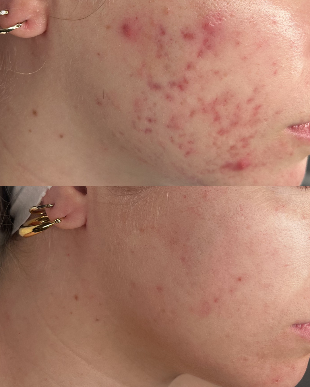Why Acne Treatment Often Fails — And What Actually Works