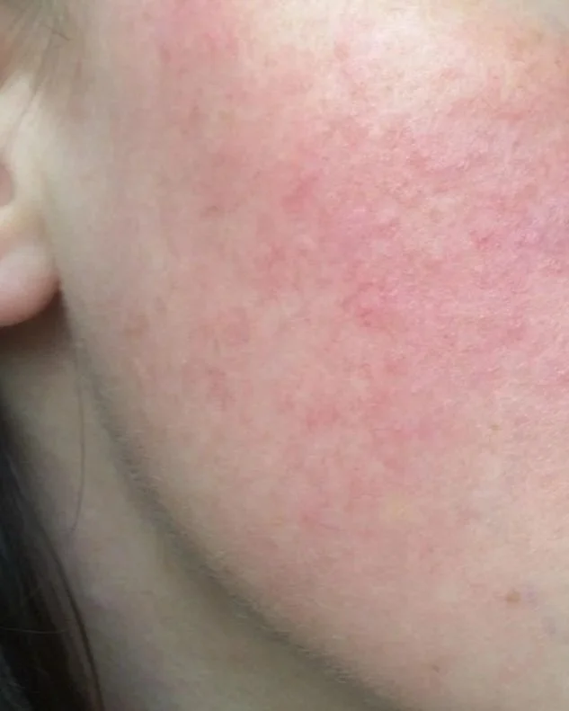 Rosacea Awareness Month — What Your Skin Is Actually Telling You