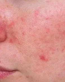Acne+Rosacea.jpg