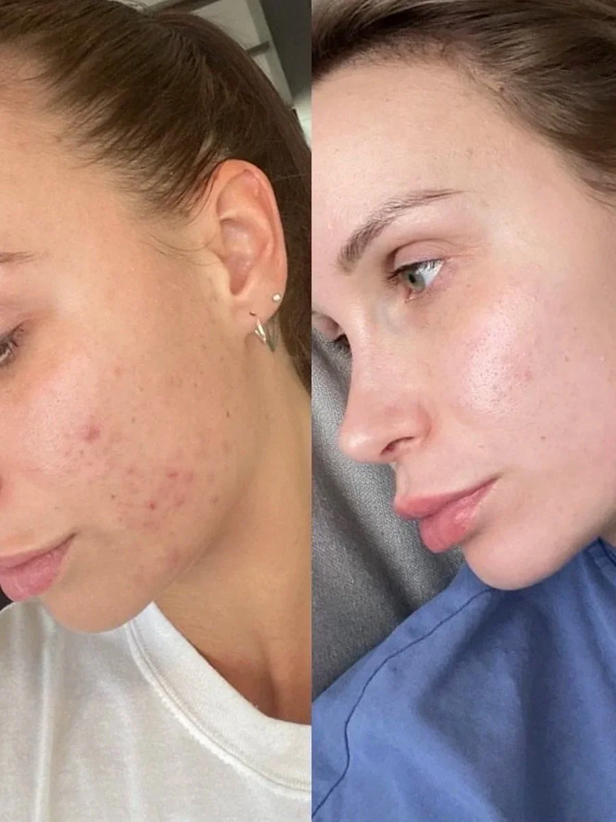 Why Does Adult Acne Keep Coming Back?