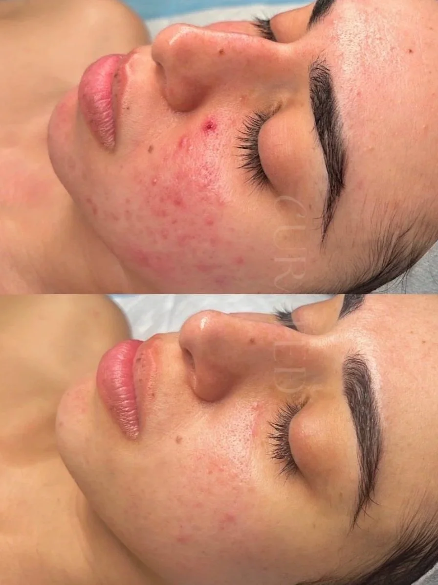 Skin Barrier &amp; Acne: can a compromised skin barrier make acne harder to manage?