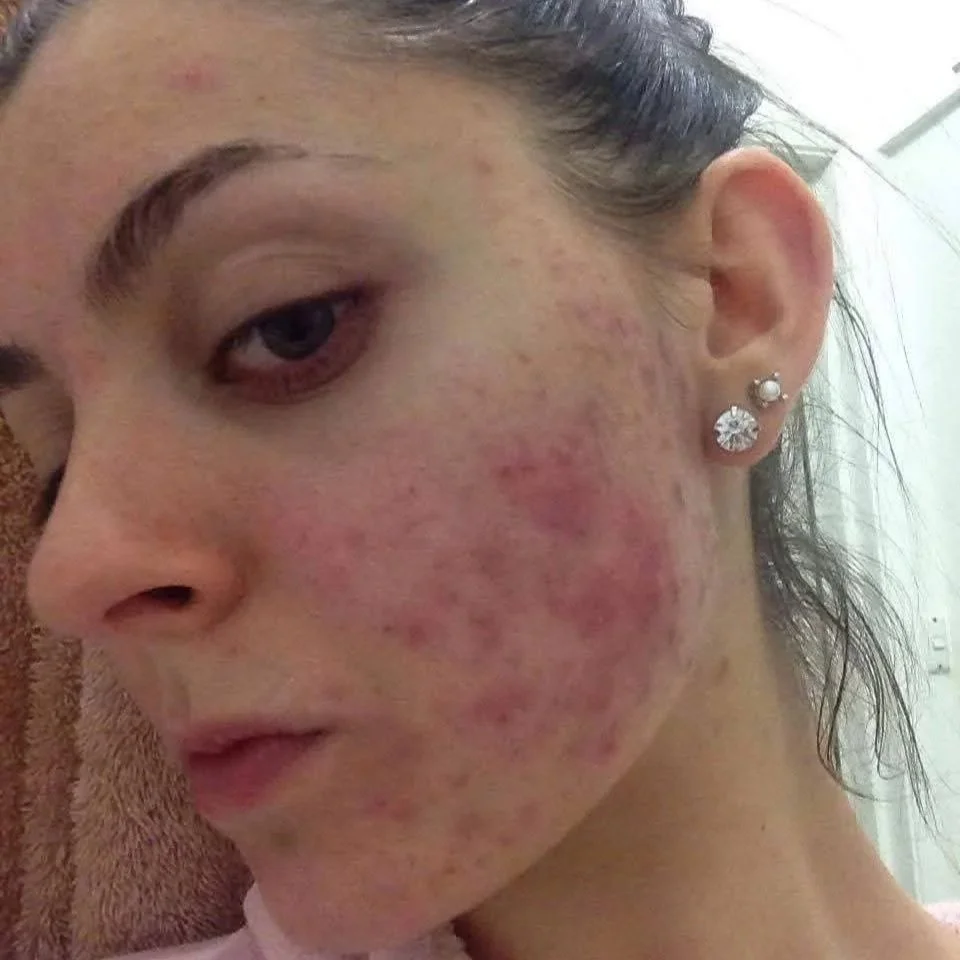 A close-up of a woman's face showing skin irritation, redness, and acne.