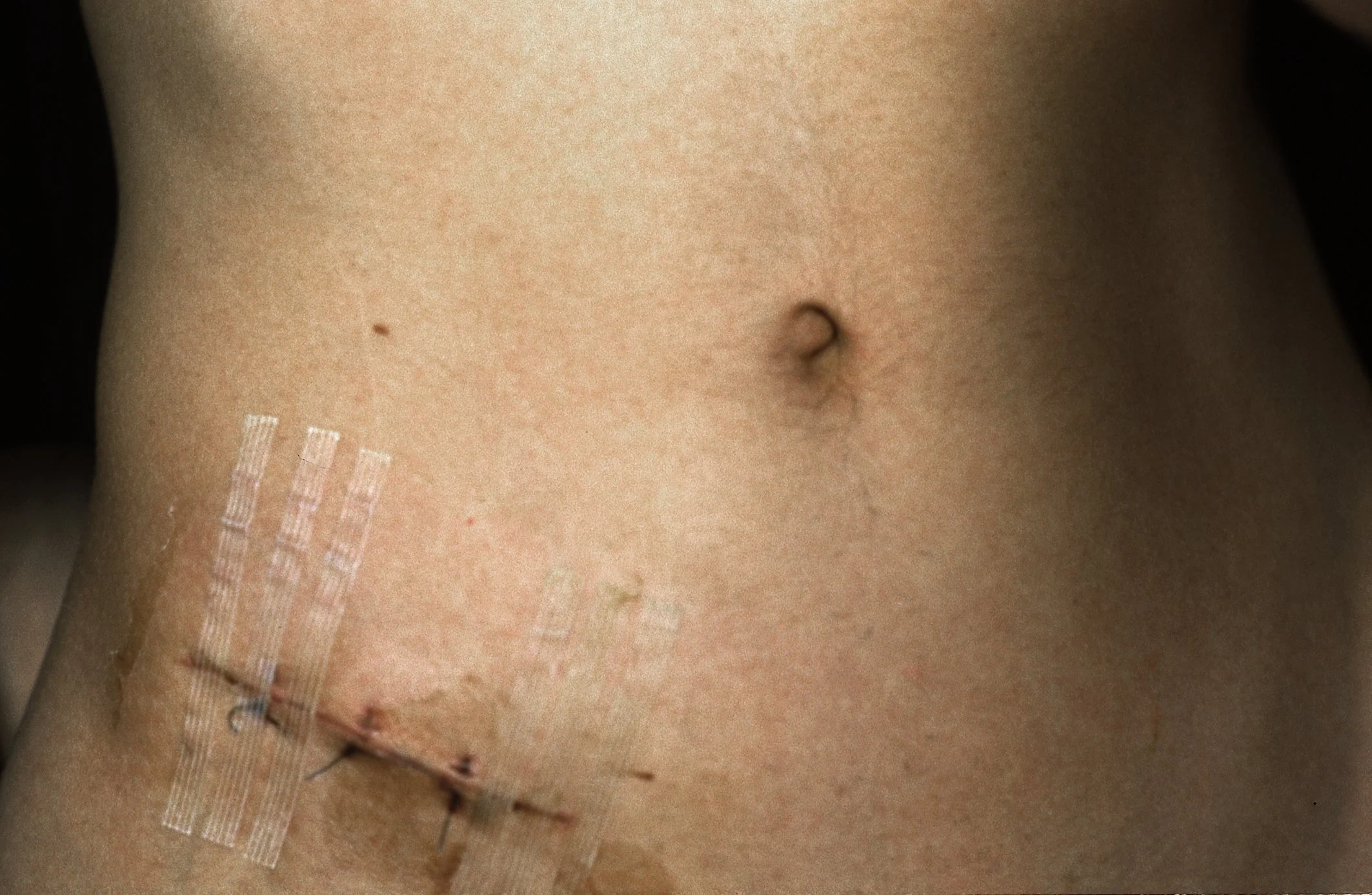 Appendix scar 1986 copy.jpg