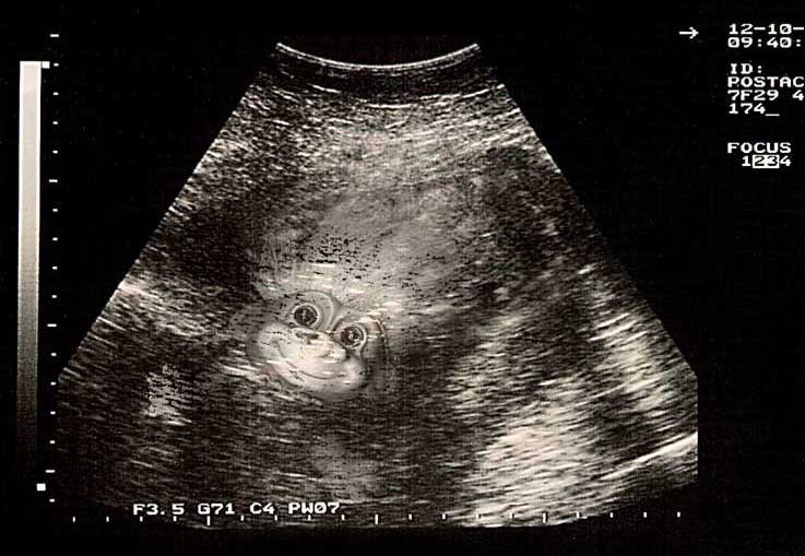 Troll foetal scan copy 2.jpg
