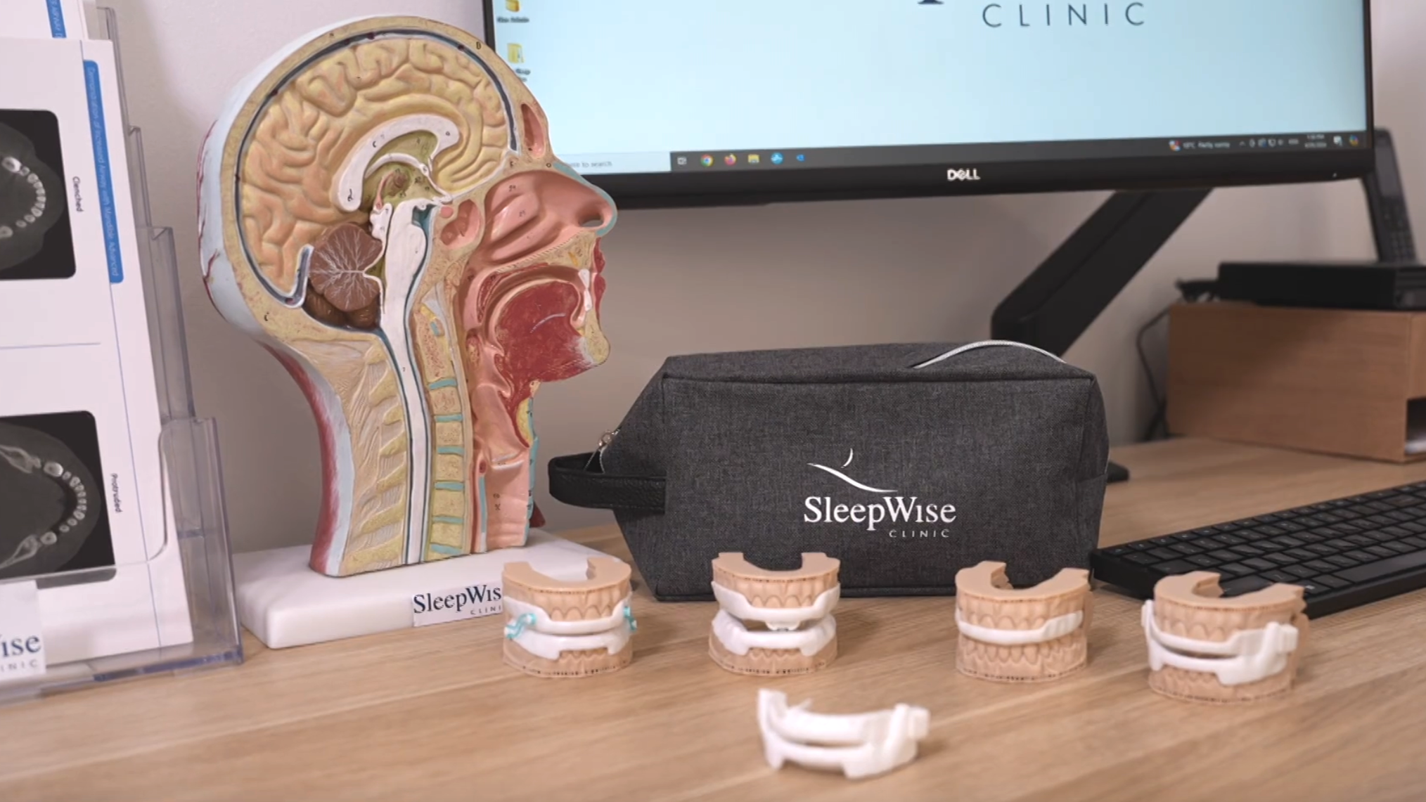 different 3D printed nylon oral appliances or mandibular advancement splints to help with treatning snoring and treating sleep apnoea
