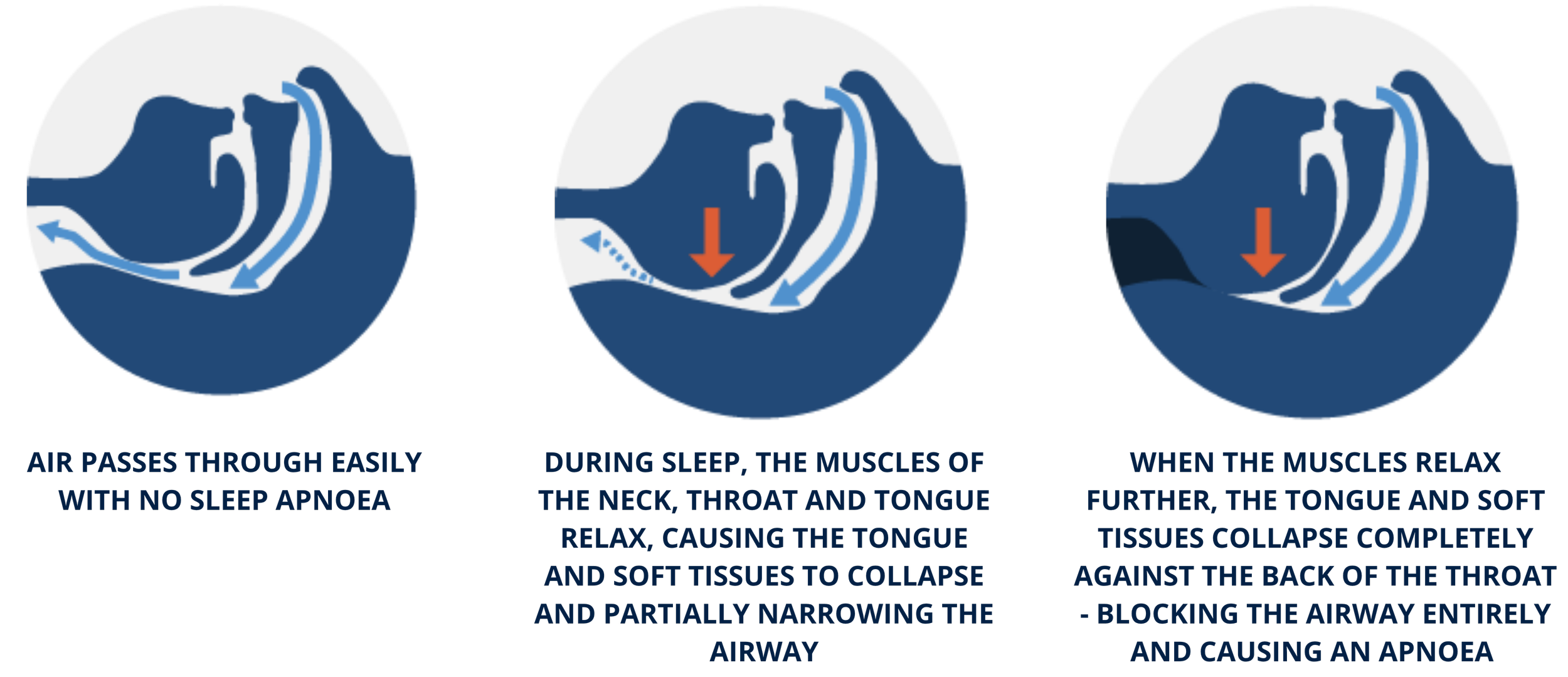 a diagram showing the process of how sleep apnoea happens which involves the narrowing the complete collapse of the airway during sleep