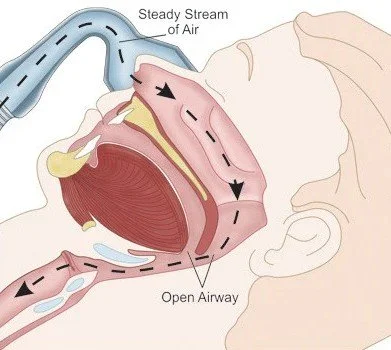 a diagram of how CPAP works to keep the airway open and not collapse when a patient is sleeping