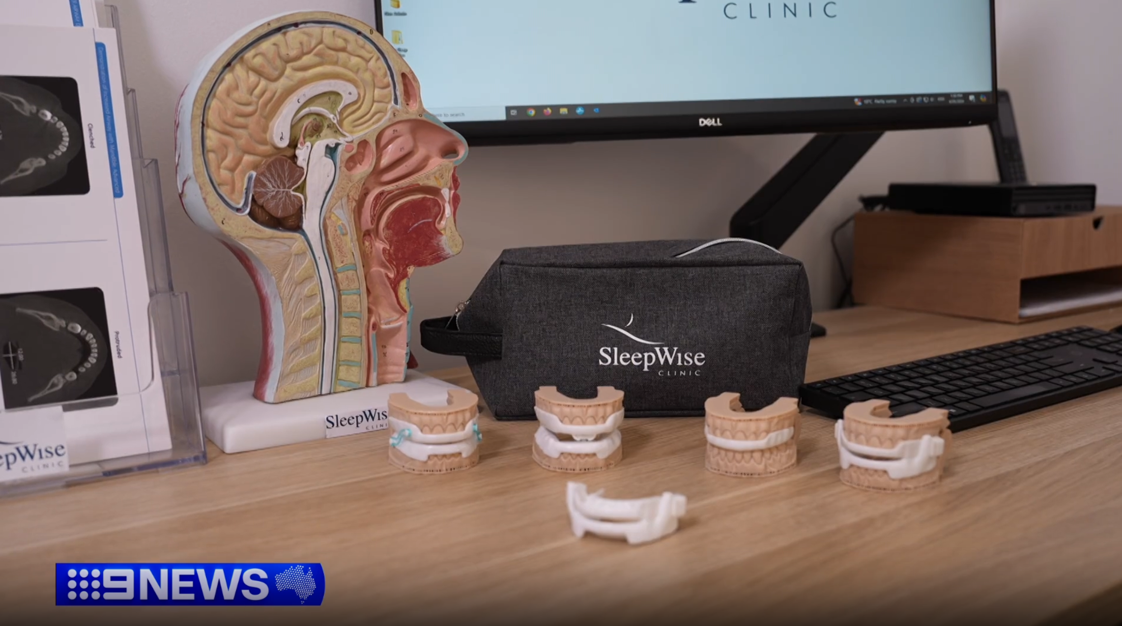 image of dental anti snoring devices to help patients manage their snoring and open up airways to breathe better