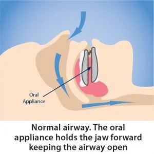 how the oral appliance holds the jaw forward to keep the airway open