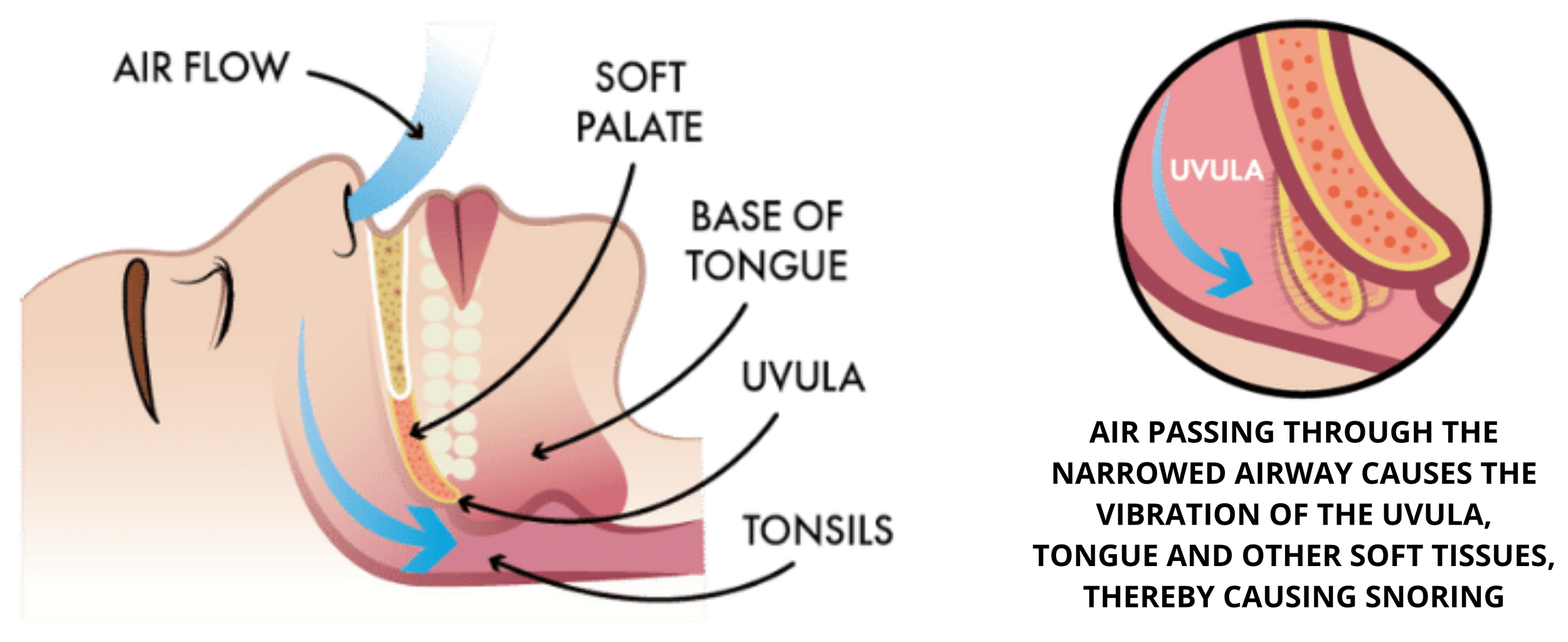 Diagram showing how snoring is caused by the narrowing of the airway where air forced through the narrowed airway causes vibration of the tongue uvula tonsils and soft tissues hence this is the cause of snoring