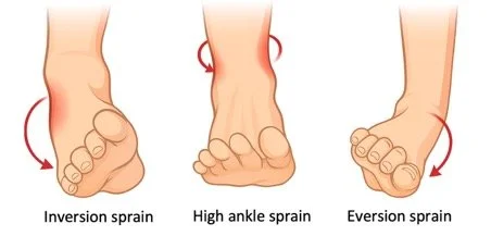 Ankle sprain problem