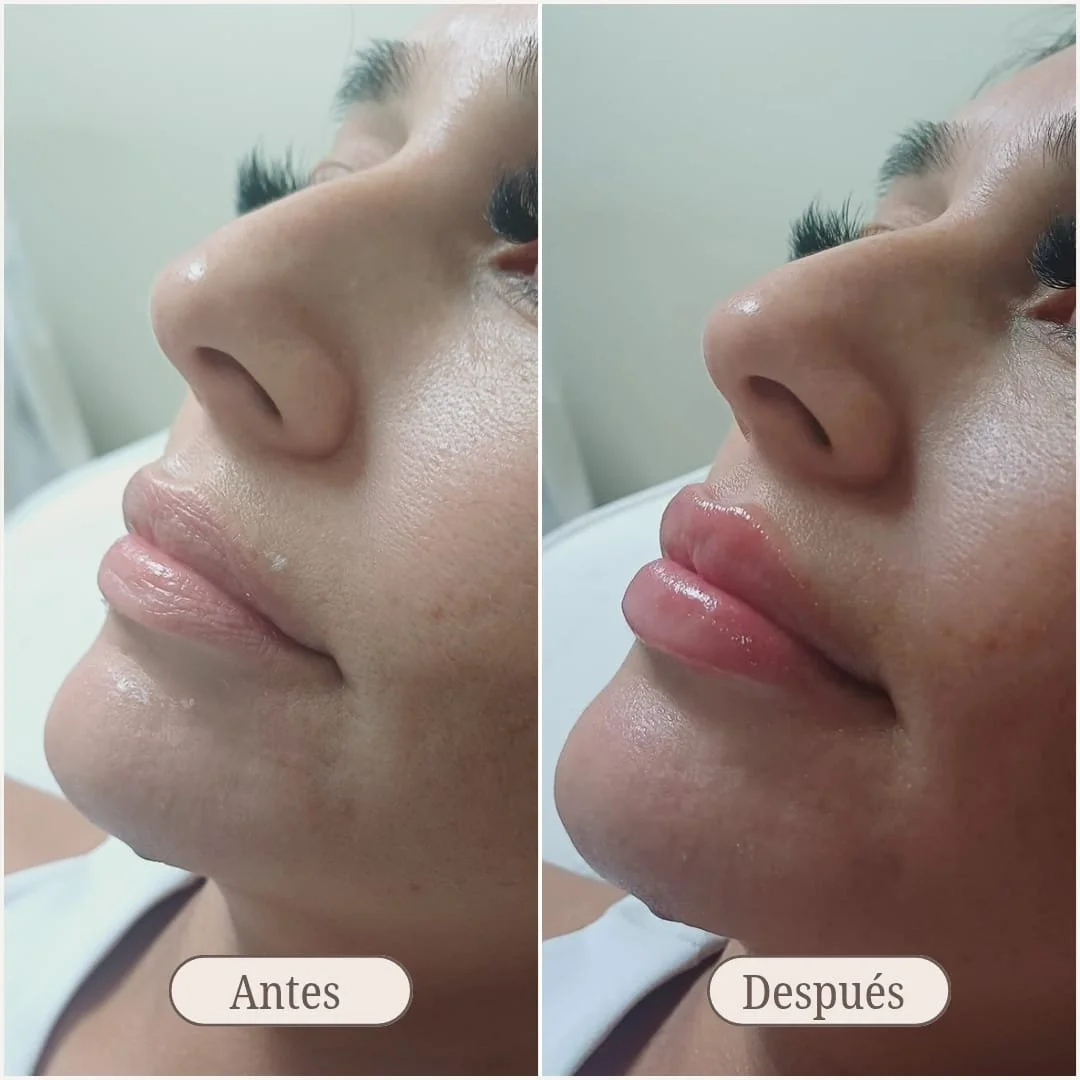 Comparación de rostro de mujer antes y después de un procedimiento estético en labios. En la izquierda, la mujer tiene labios menos definidos, y en la derecha, labios más llenos y con brillo, mostrando un resultado mejorado.