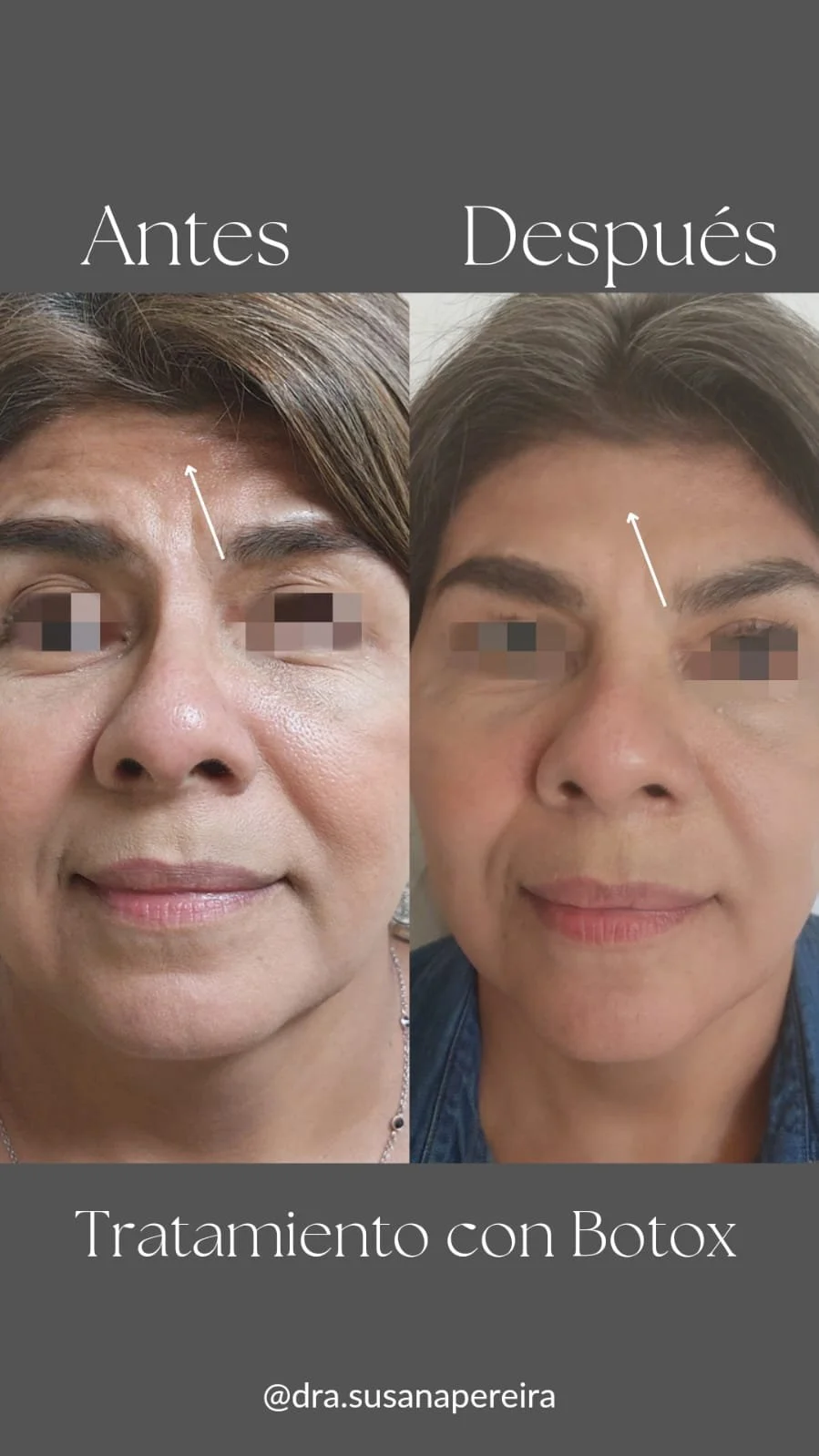 Imagen comparativa de una mujer antes y después de un tratamiento con Botox, con texto en español que dice 'Antes', 'Después' y 'Tratamiento con Botox', y el nombre de usuario '@dra.susanapereira'.