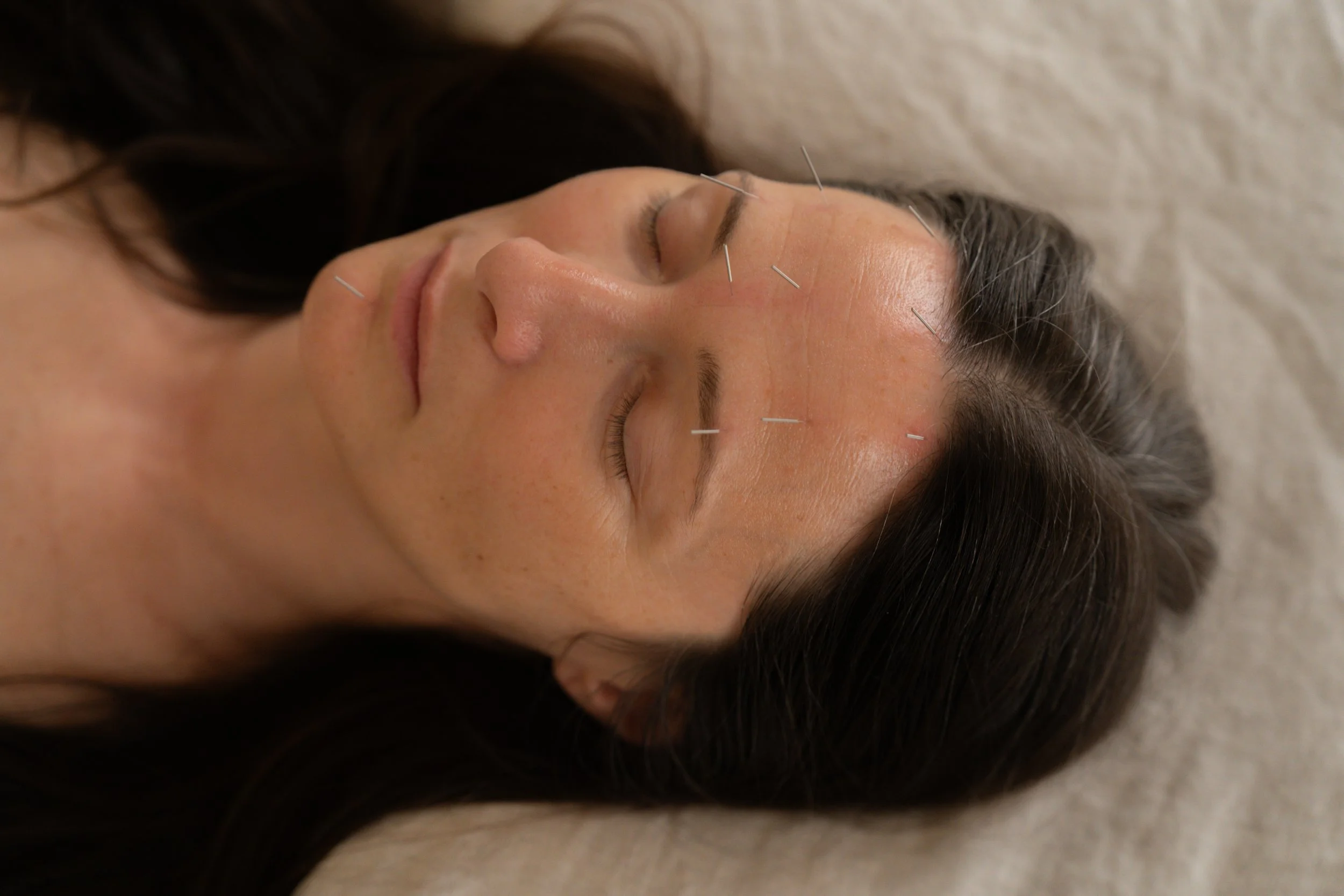 A woman lying down with acupuncture needles inserted in her forehead, closed eyes, and dark hair spread around her head.