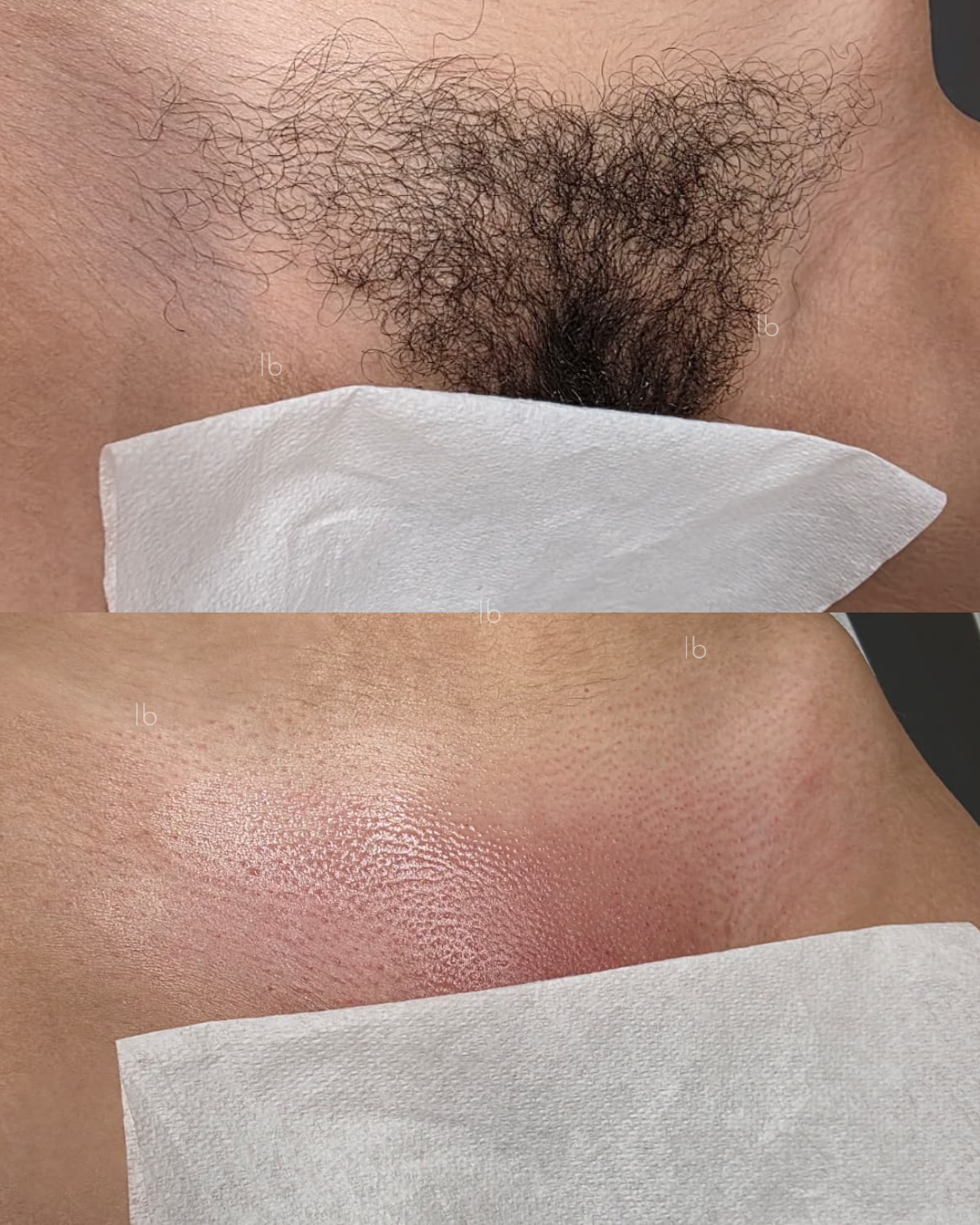 Before and after Brazilian, a smooth, hairless area of skin on the side of the body, also covered by a white tissue.