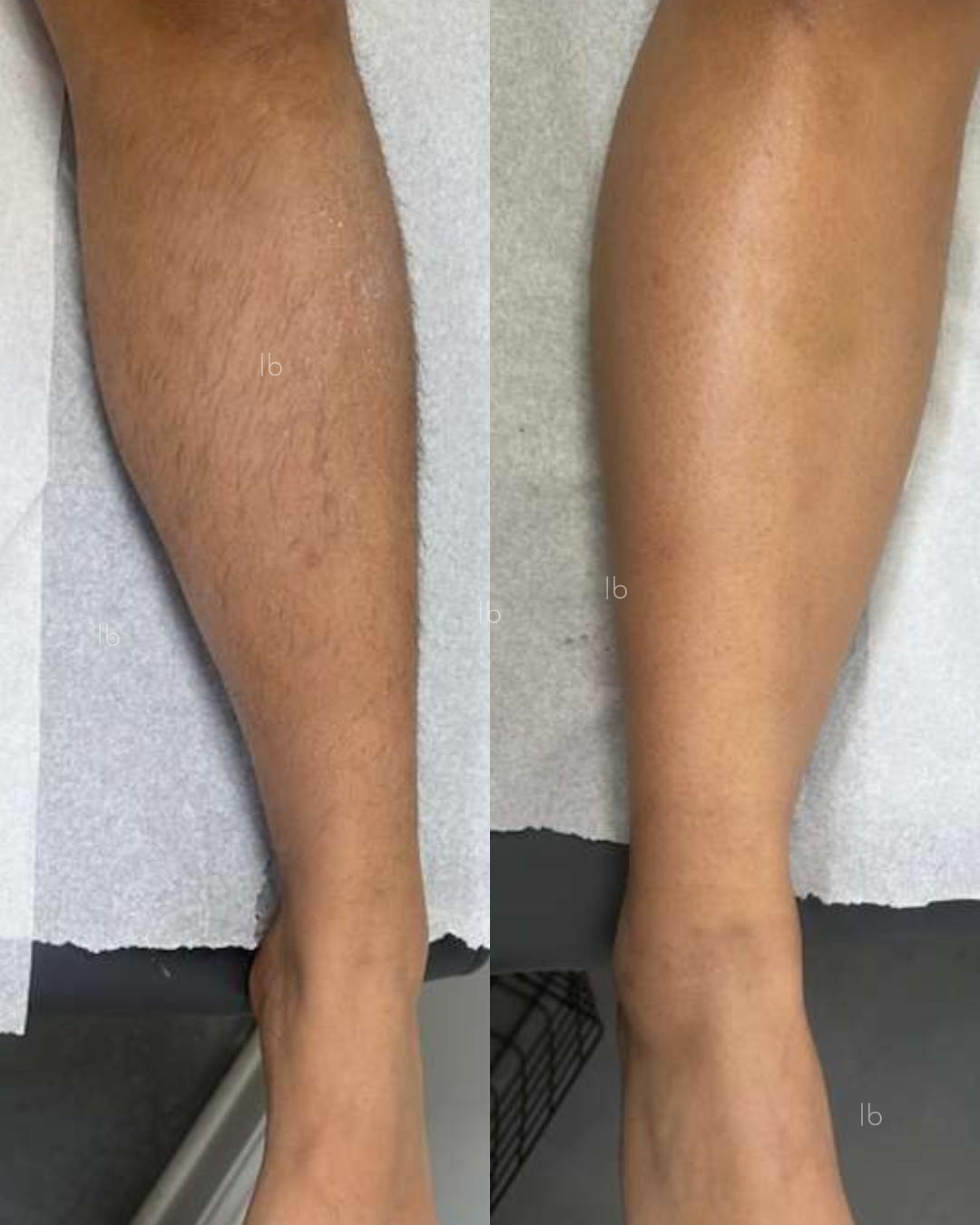 Comparison of a person's leg showing before and after hair removal, with the left side featuring hairy skin and the right side showing smooth, hair-free skin.