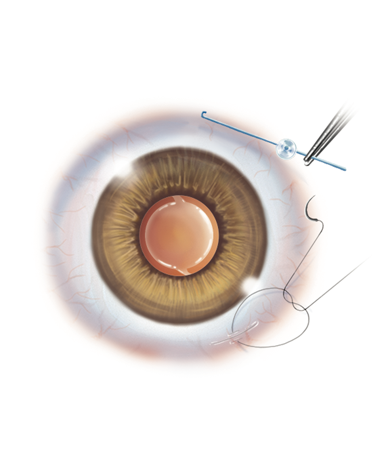 Cataract Surgery