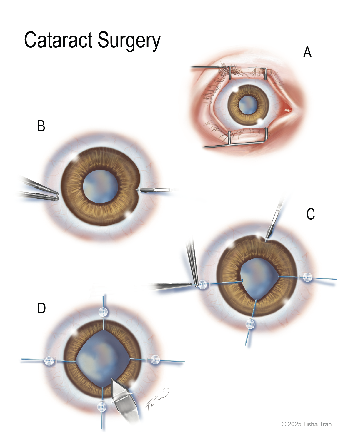 Cataract Surgery DPI 150.png