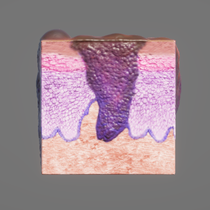 Skin Cancer Model