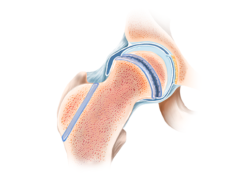 SCFE Journal Illustration