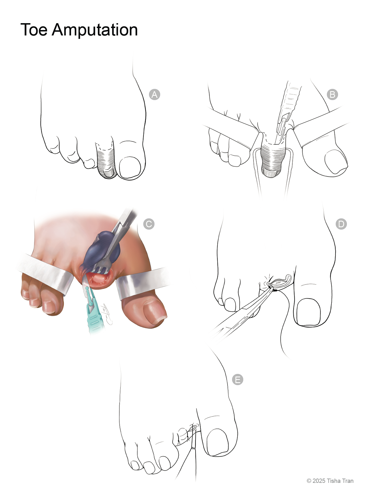Toe amputation DPI 72.png
